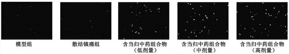 Traditional Chinese medicine composite containing angelica sinensis and having function of treating endometriosis