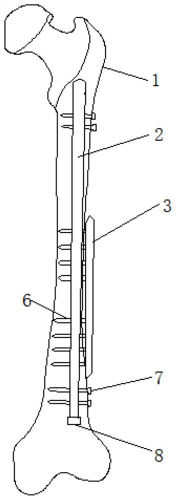 Femoral porous intramedullary nail combined auxiliary steel plate double cortical screw internal fixation system