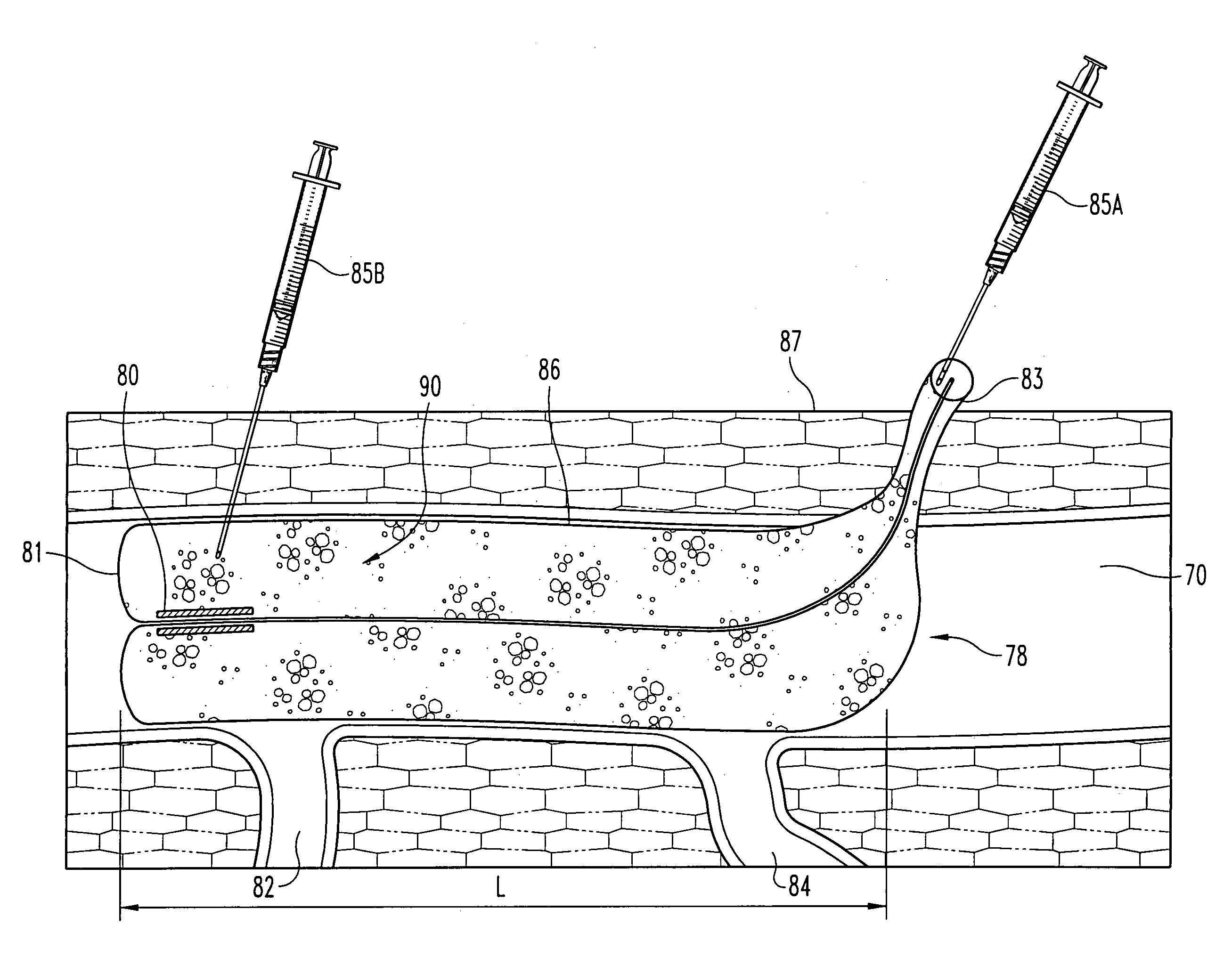 Inverting occlusion devices, methods, and systems