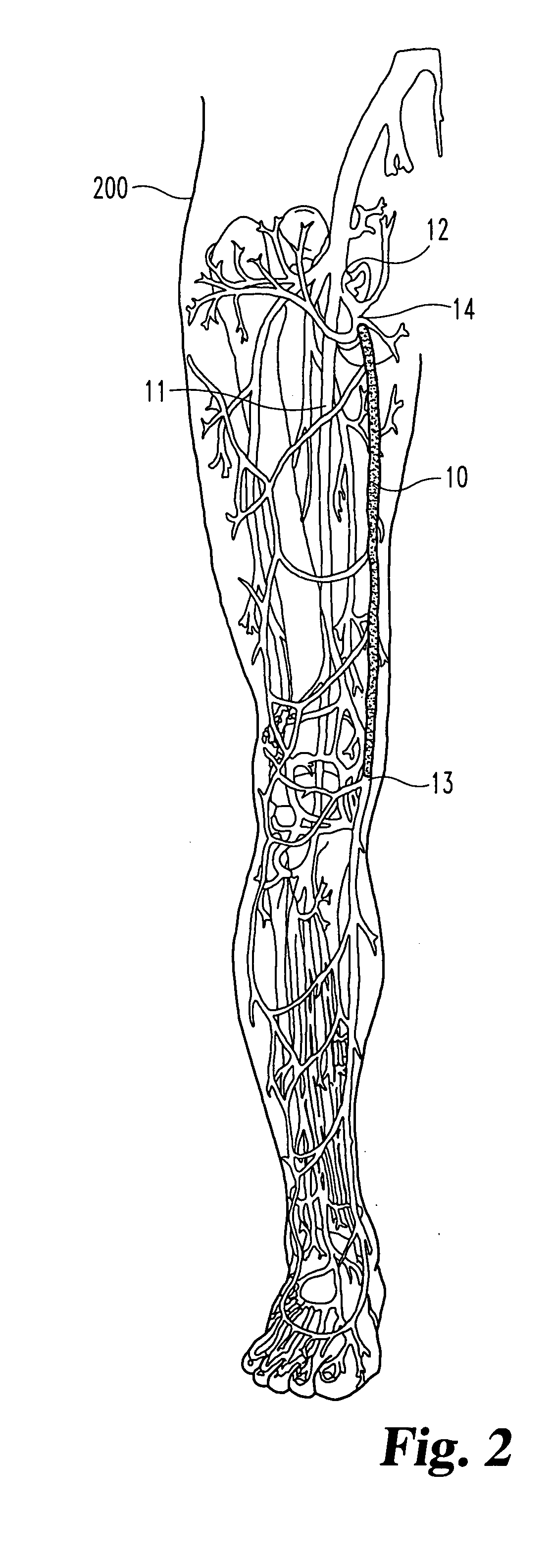 Inverting occlusion devices, methods, and systems