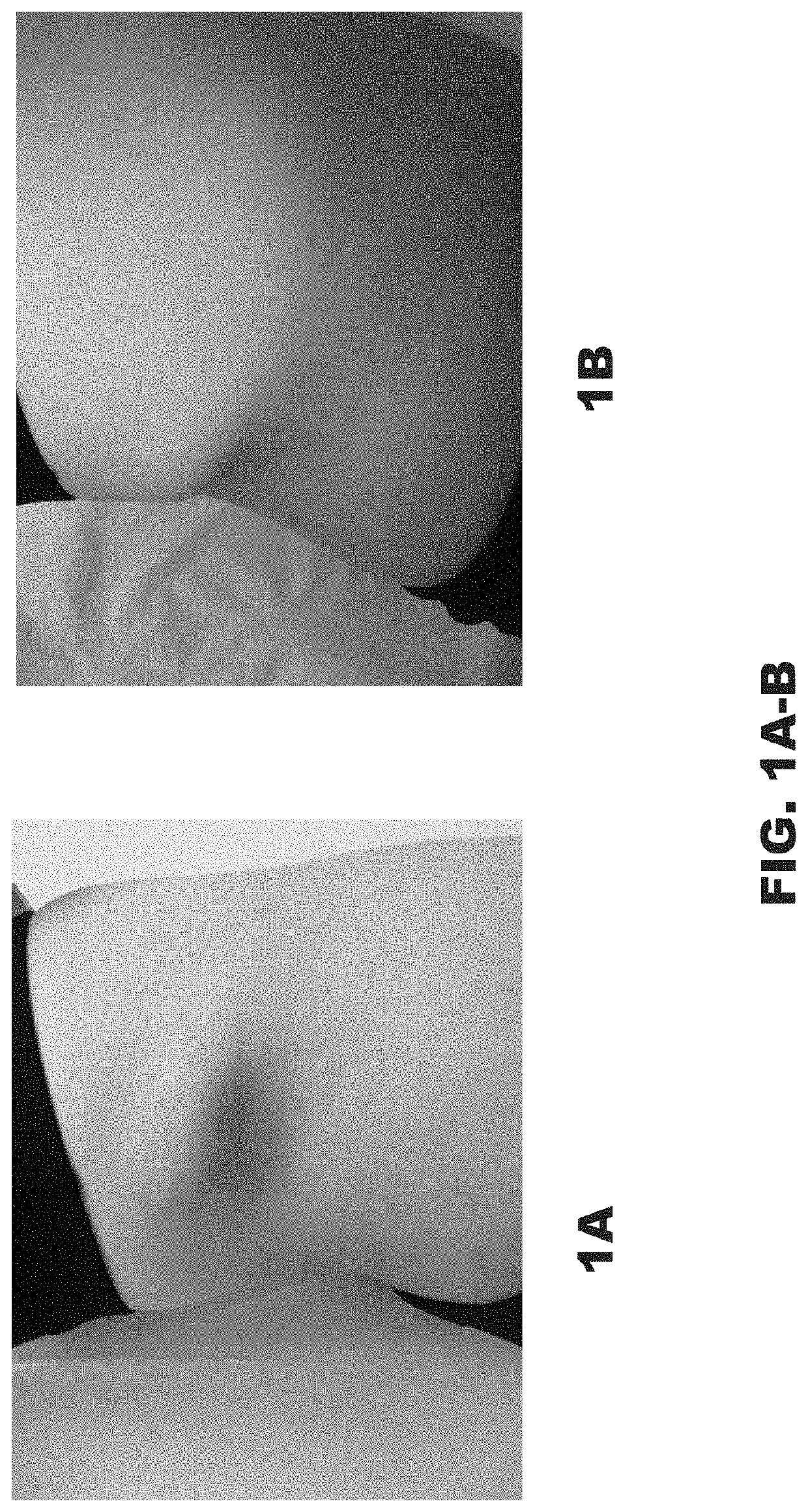 Methods of Treating Residual Lesions of Vascular Anomalies