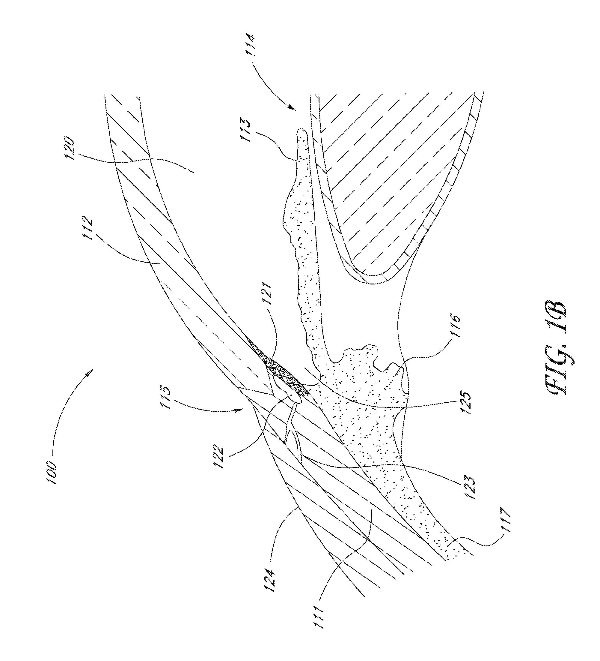 System for delivering multiple ocular implants