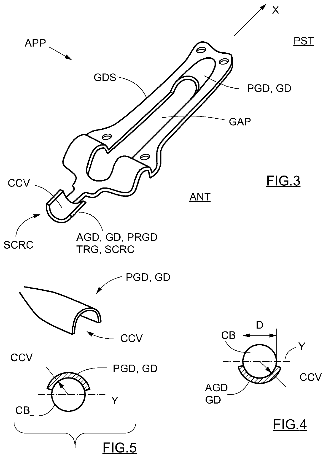 Apparatus for zygomatic implantation and method