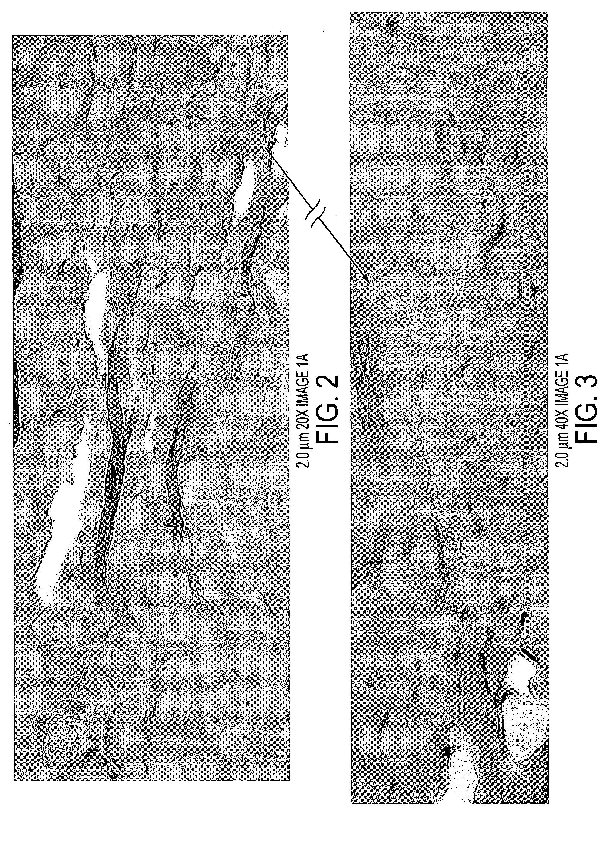 Intradermal cellular delivery using narrow gauge micro-cannula