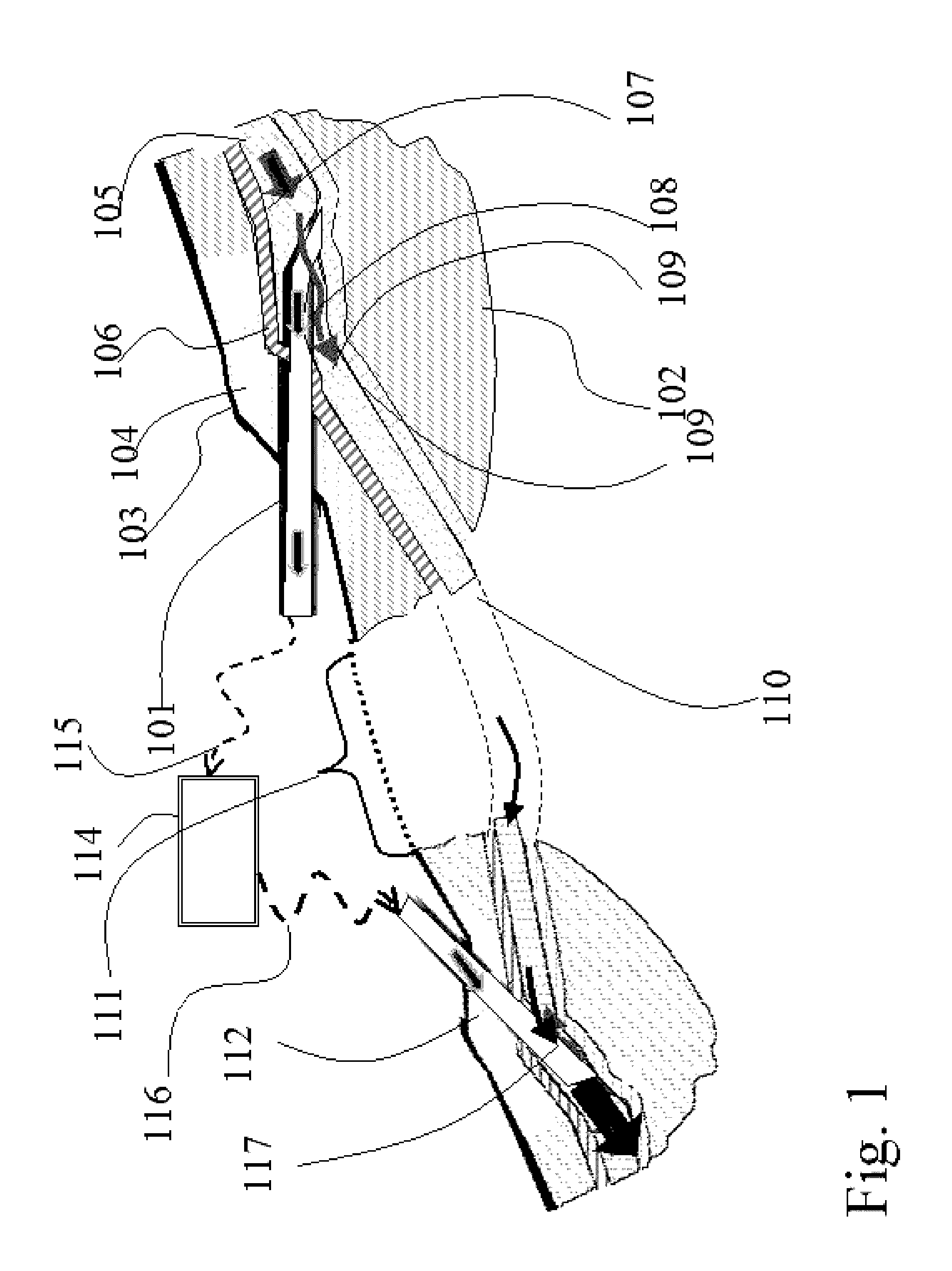 Enhanced cannulation method and needles