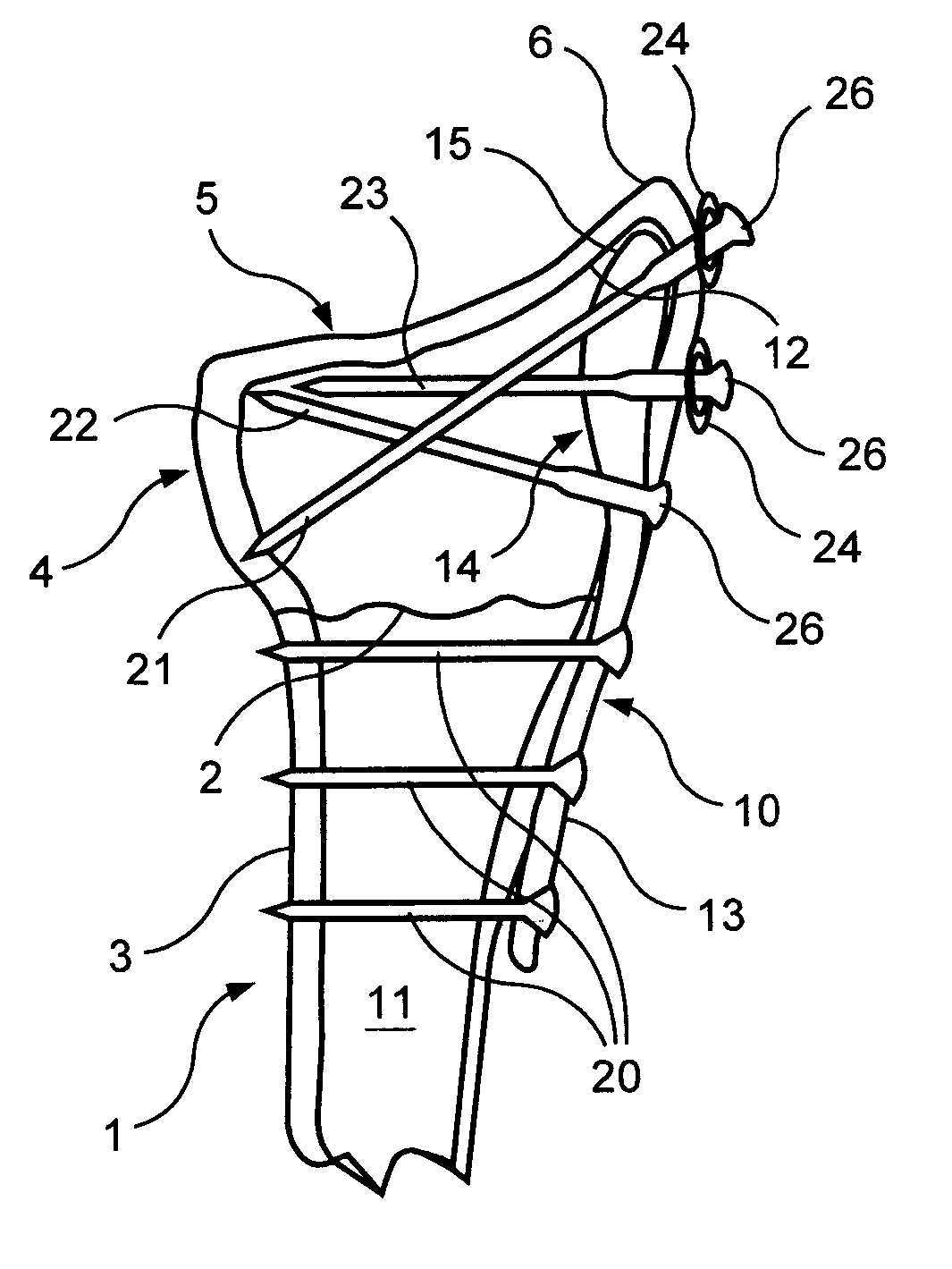 Intramedullary implant for fracture fixation