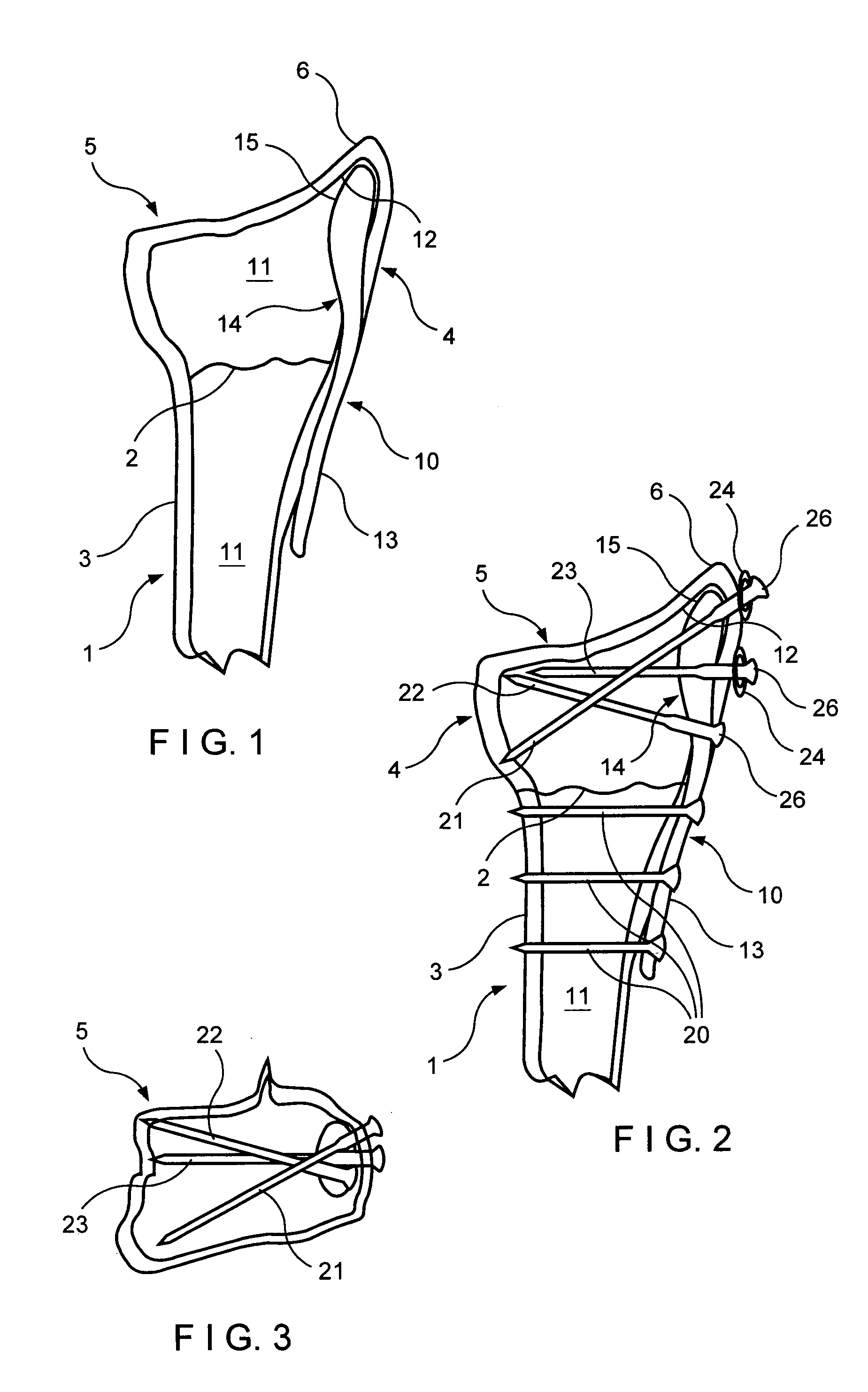 Intramedullary implant for fracture fixation