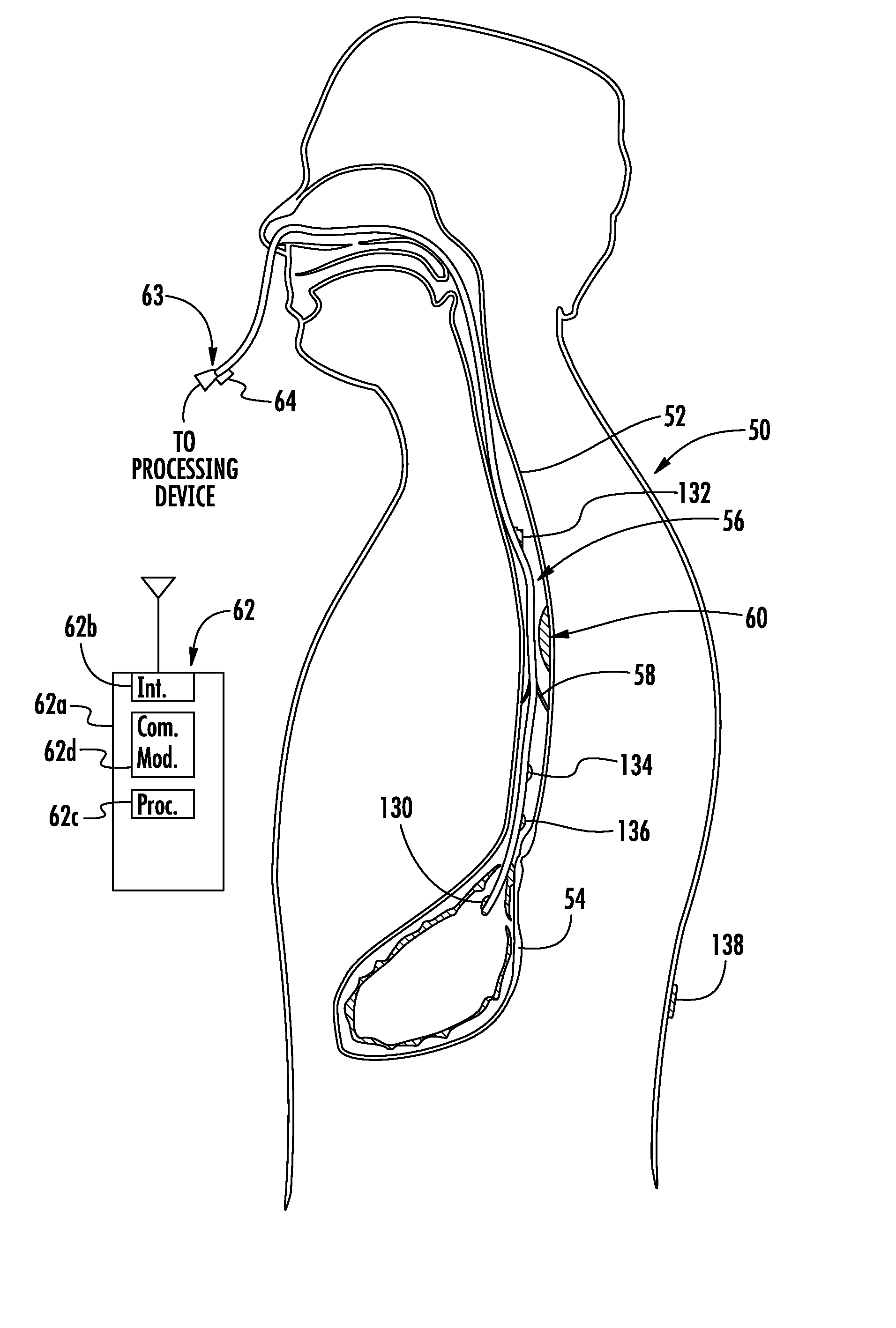 Device to block emesis and reflux and associated system and method