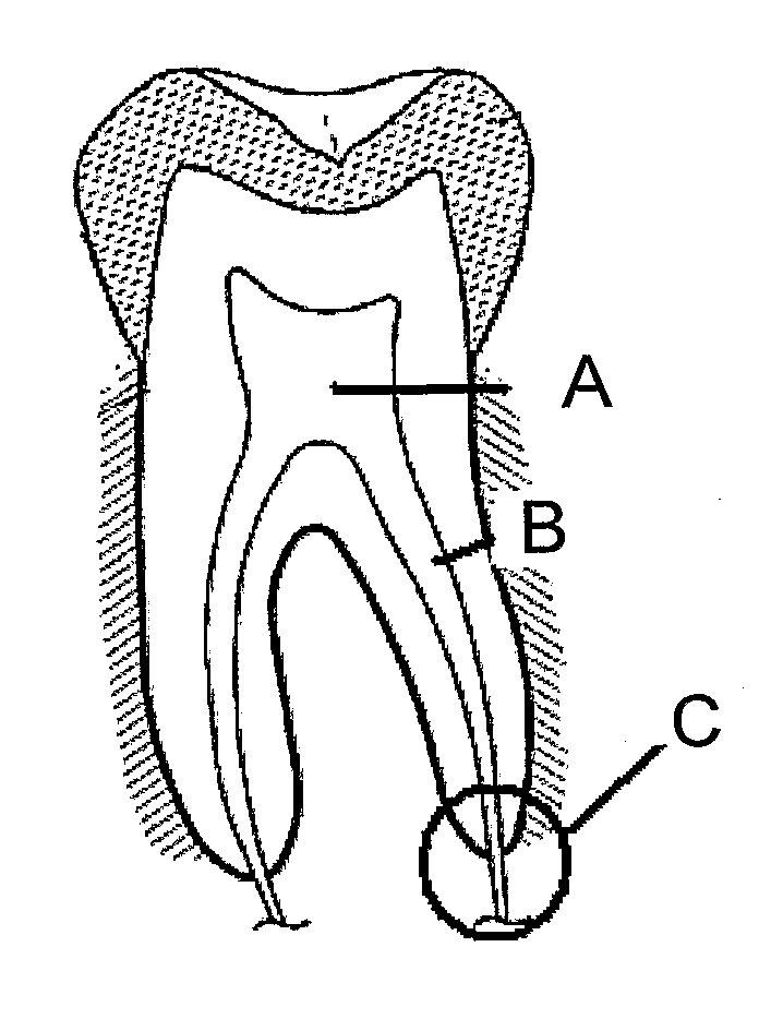 Aluminous cement-based composition for application in endodontics and cementitious product obtained thereof