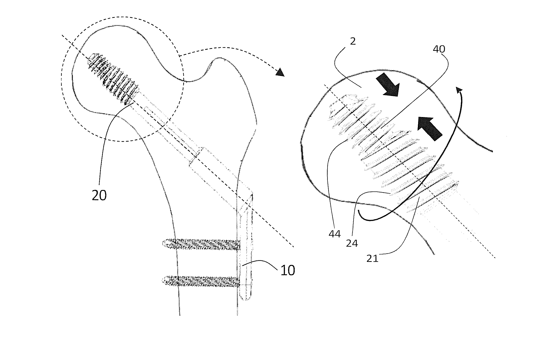 Bone screw assembly