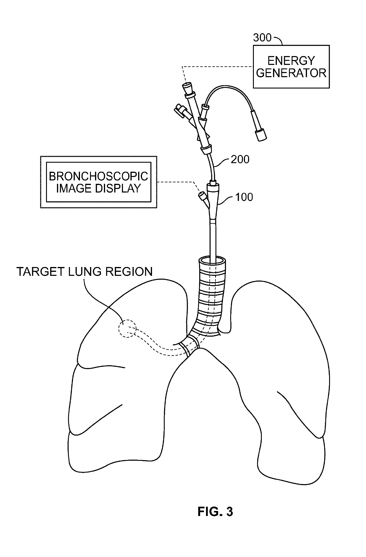 Method for treating emphysema with condensable thermal vapor