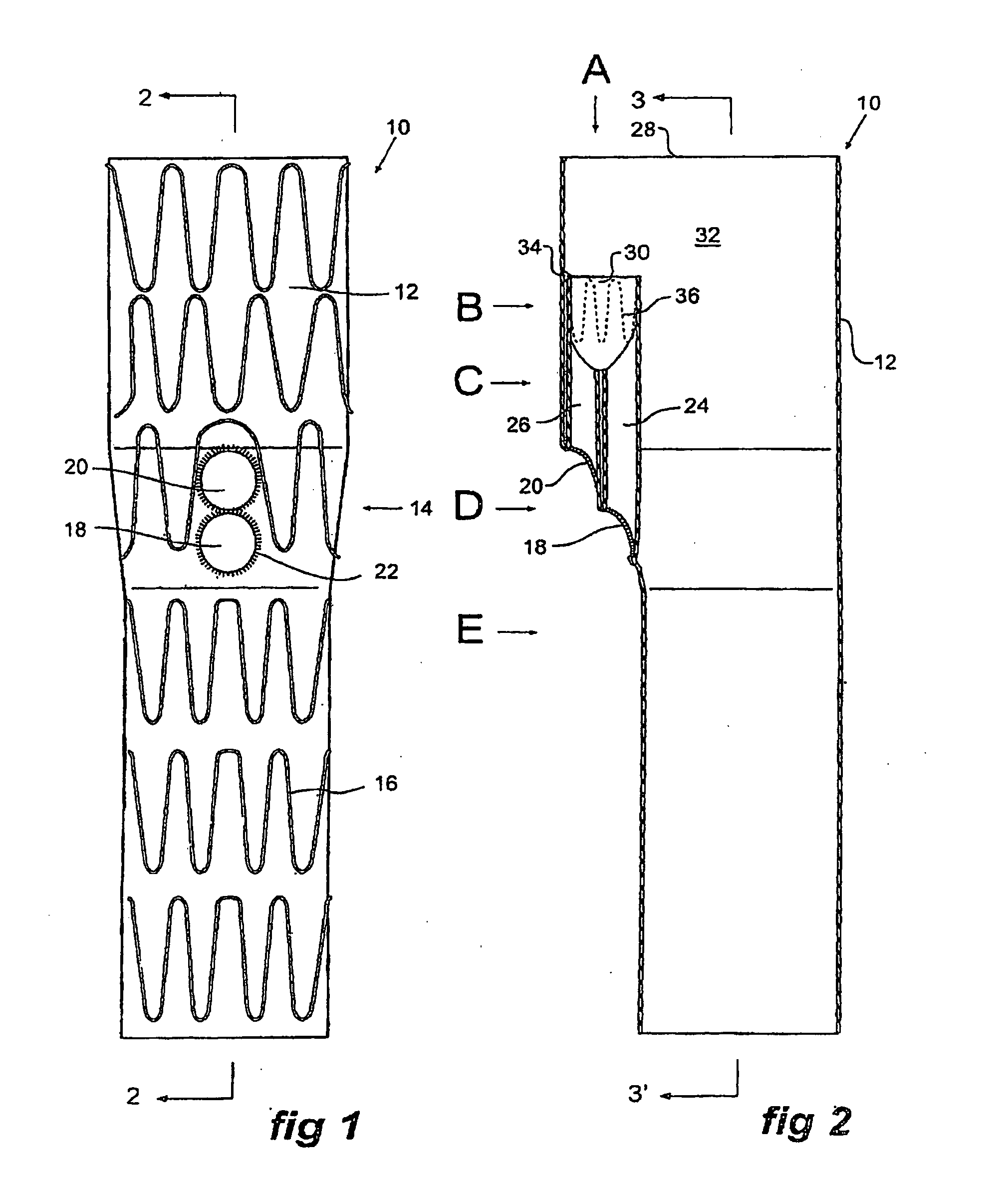 Stent graft