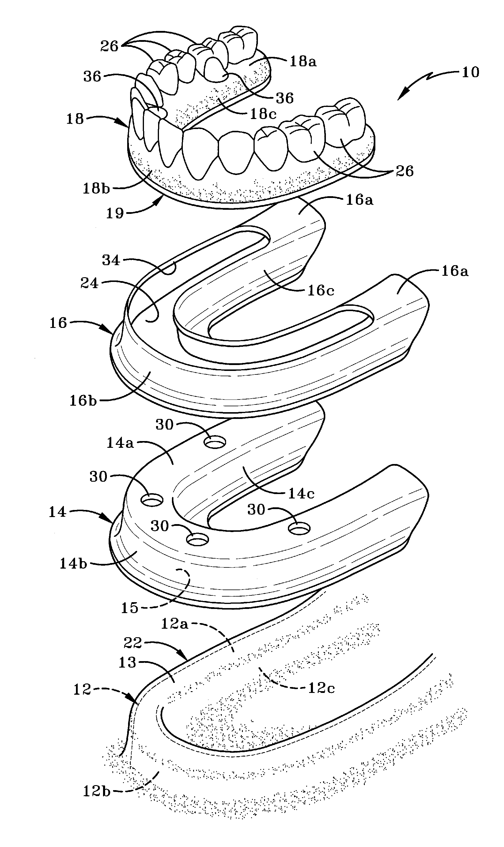 Method of installing a final dental prosthesis