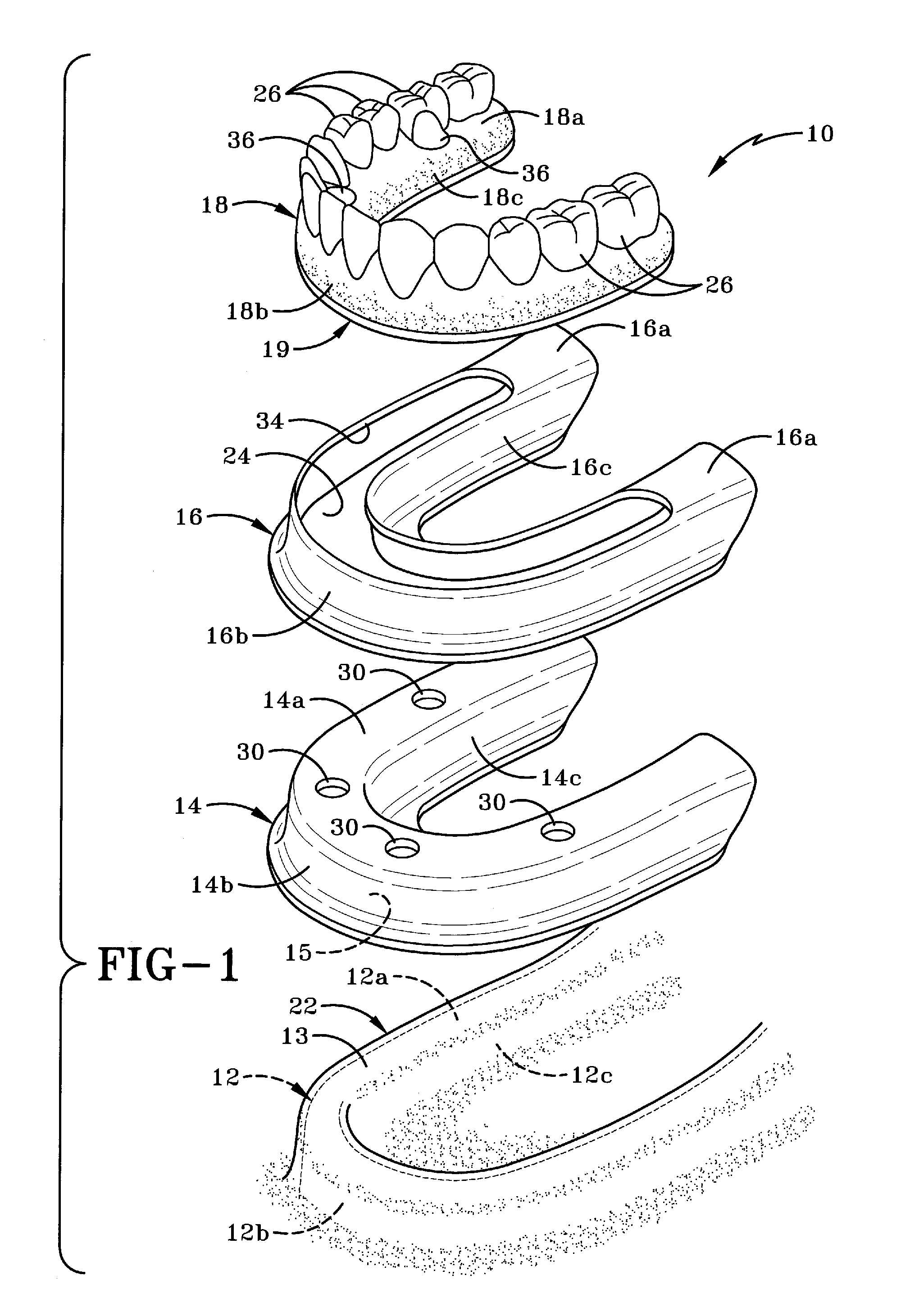 Method of installing a final dental prosthesis