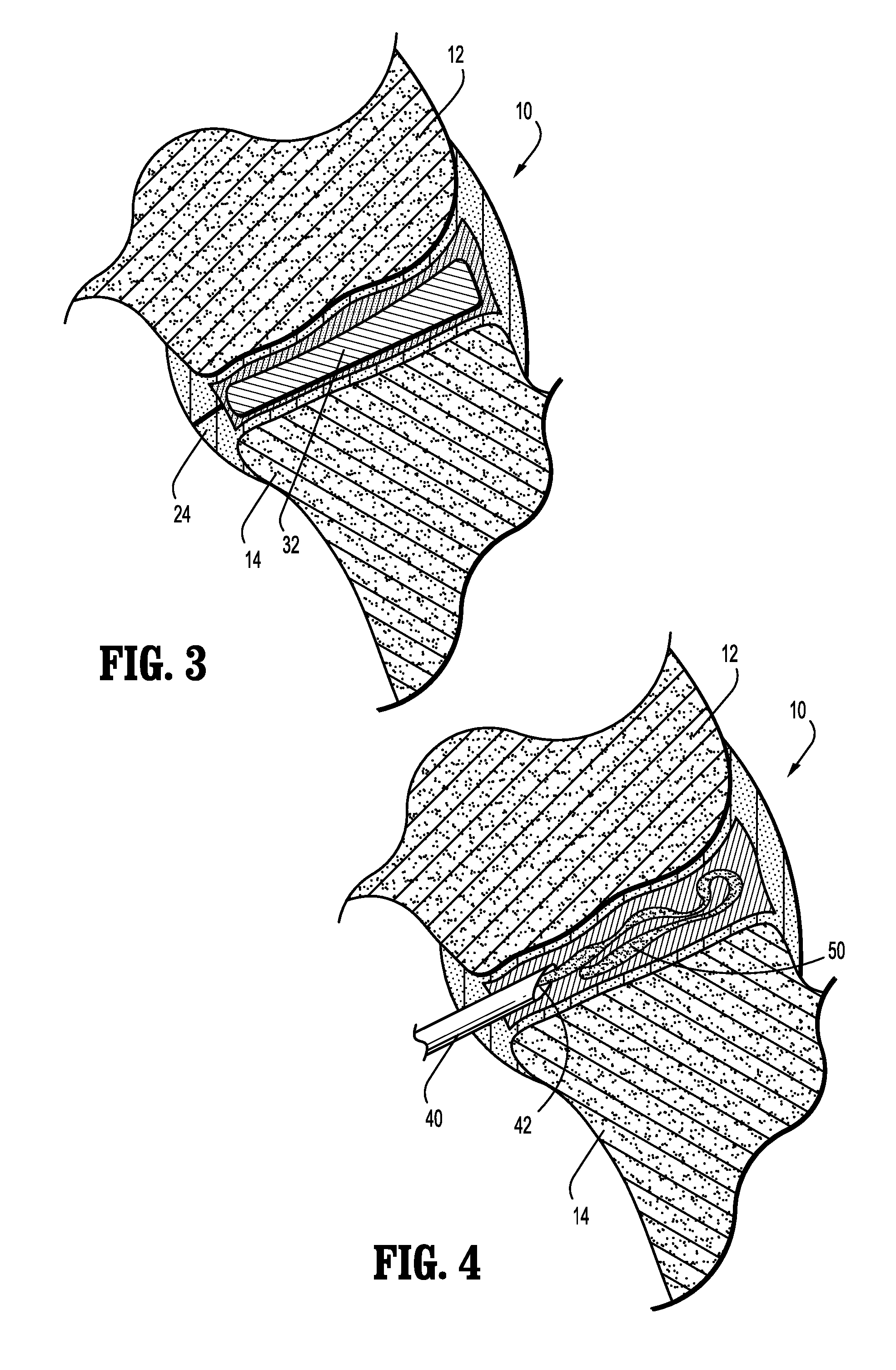 Spinal facet augmentation implant and method