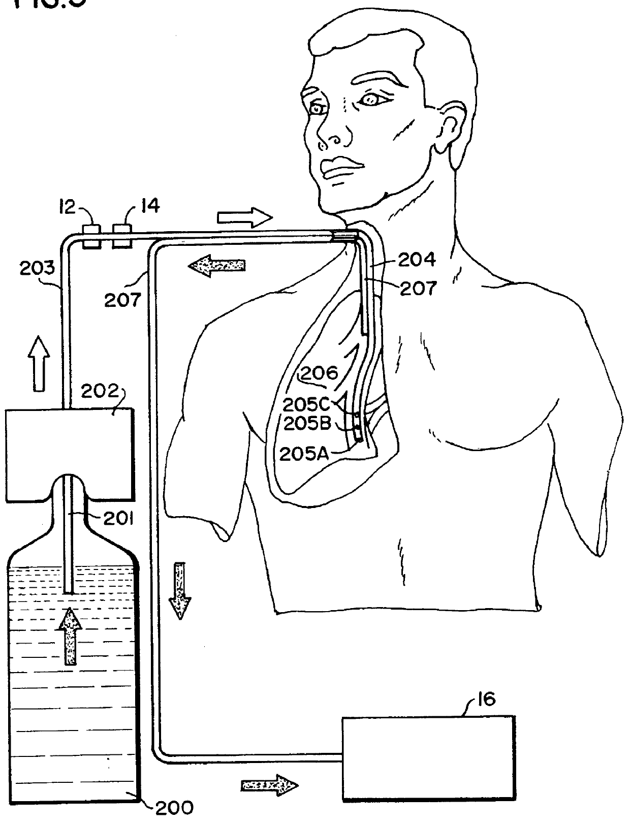 Apparatus and method for the rapid induction of hypothermic brain preservation