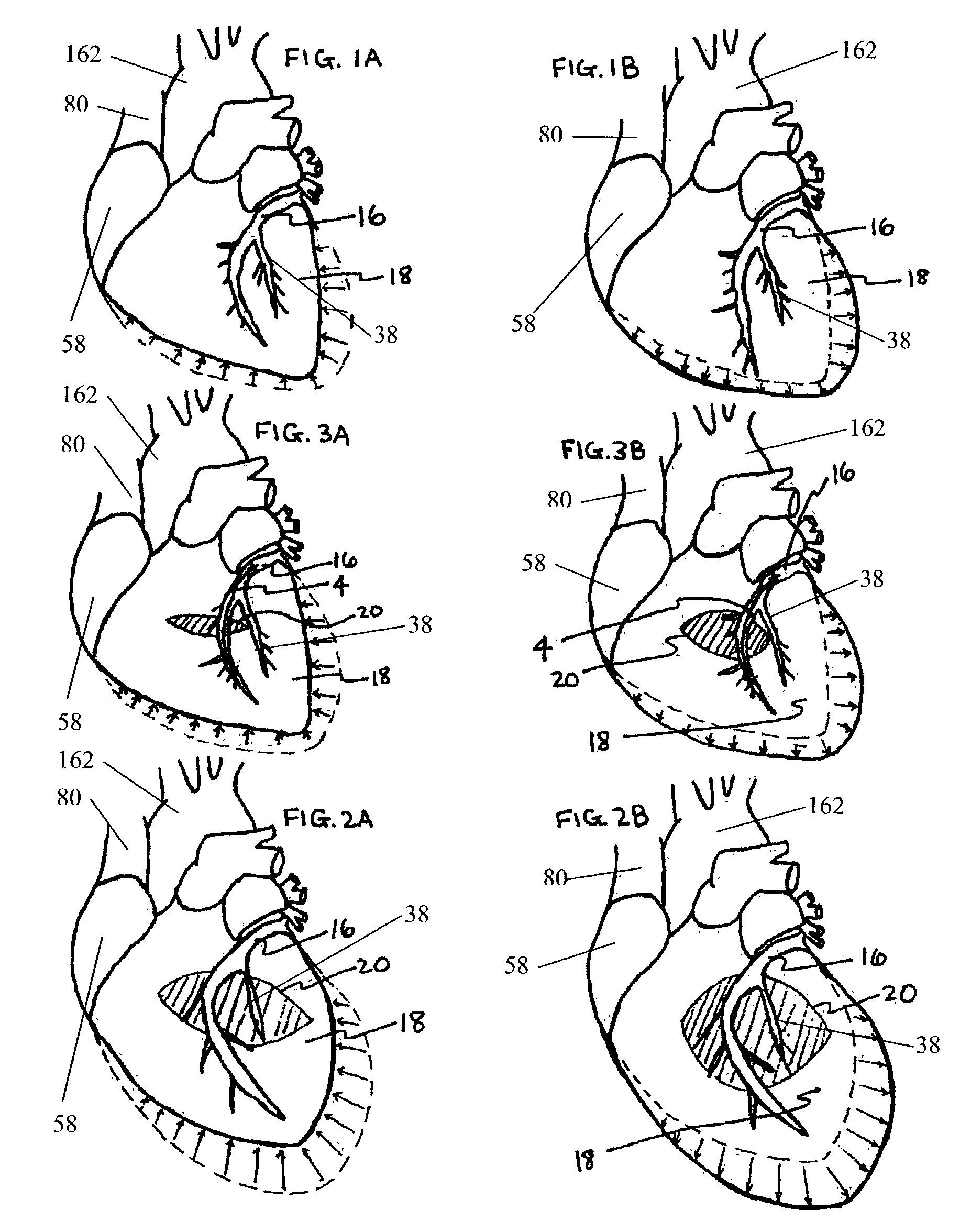 Systems for heart treatment