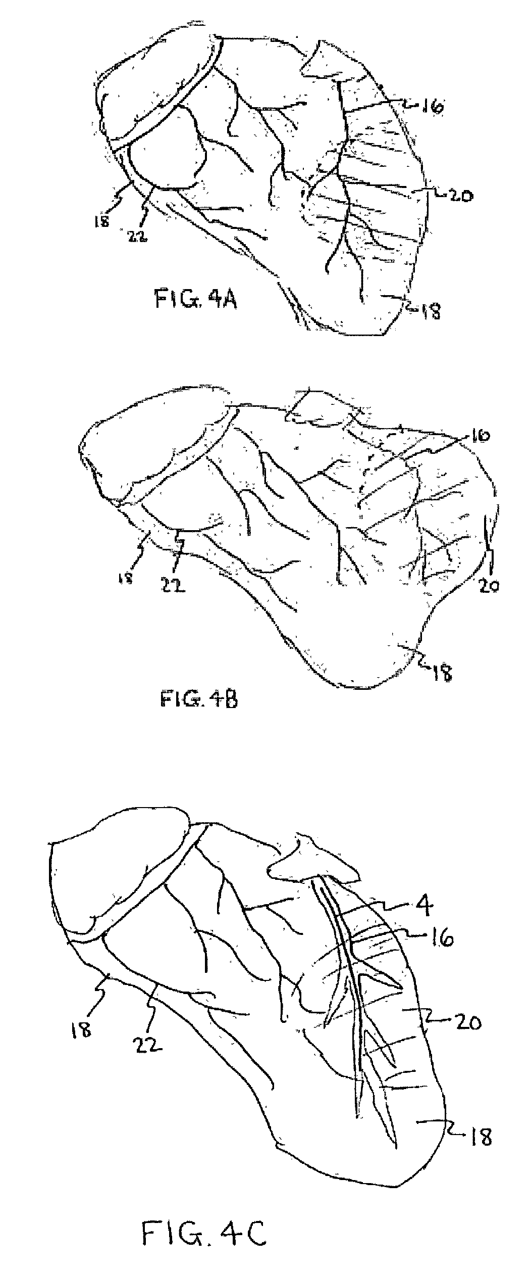 Systems for heart treatment