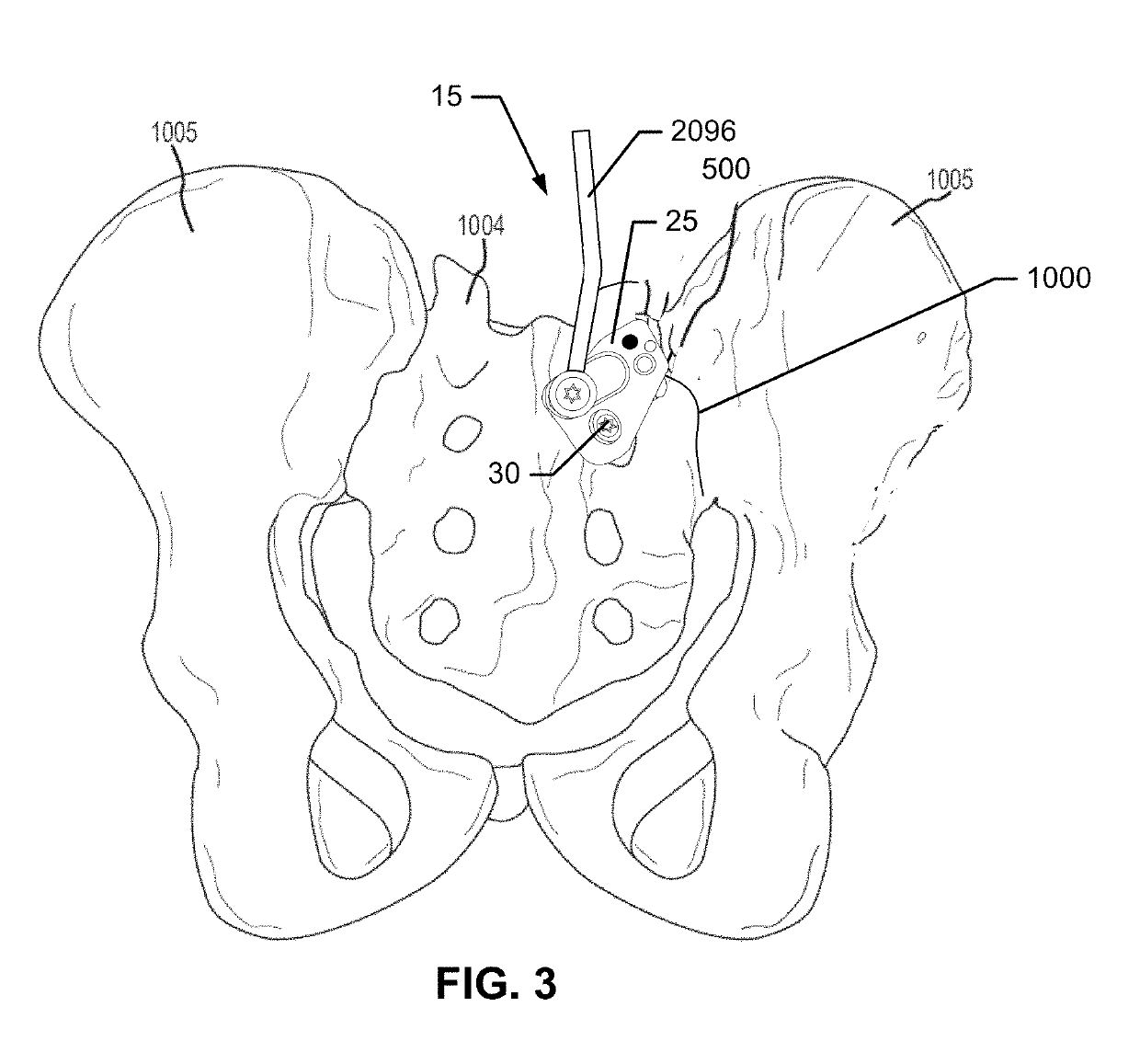 Systems and methods for fusing a sacroiliac joint and anchoring an orthopedic appliance