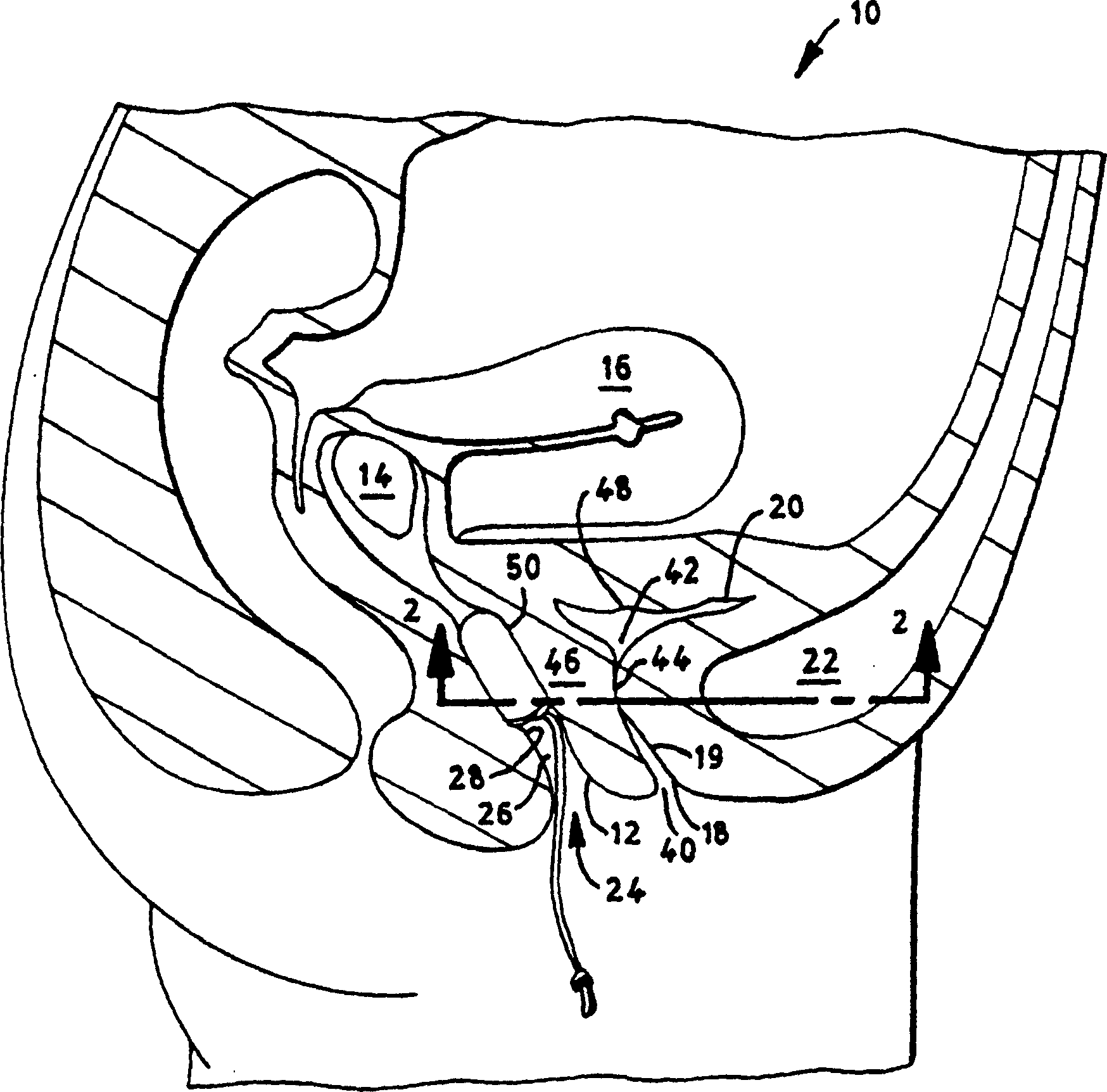 Method for alleviating female urinary incontinence