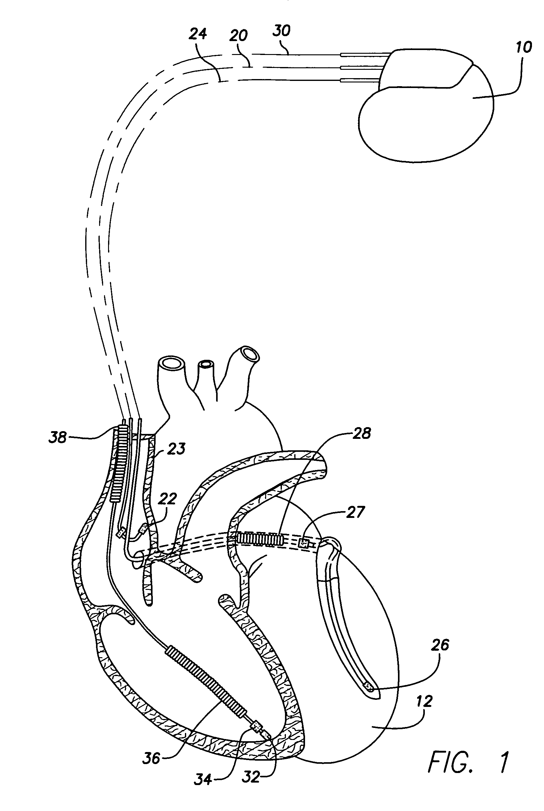 Modification of evoked response detection algorithm based on orientation and activity of patient