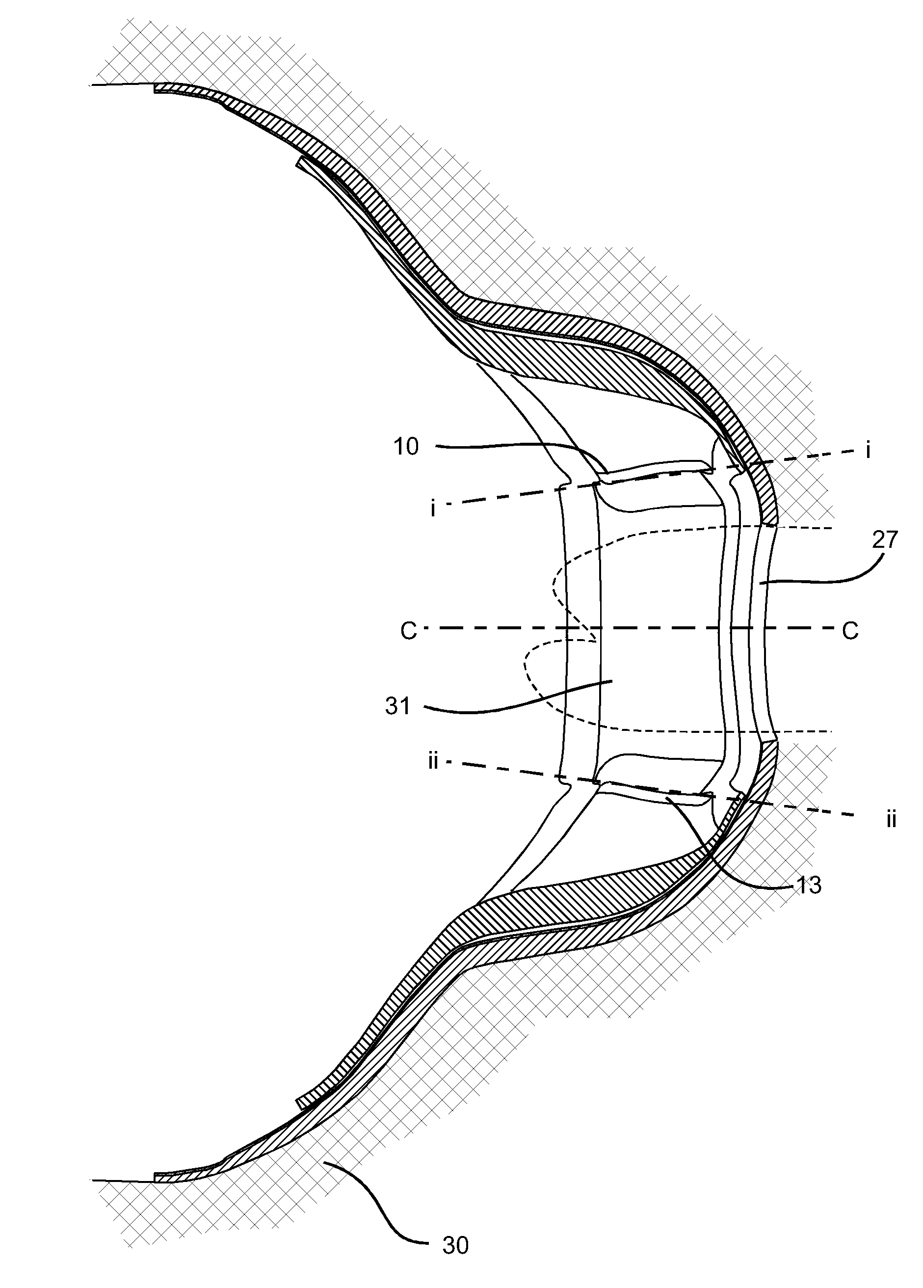 To control bending in a skin plate for use in an ostomy appliance