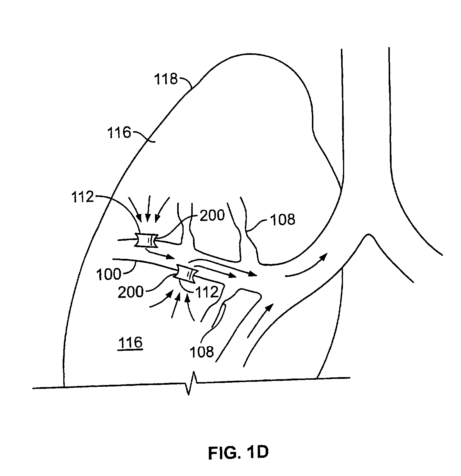 Devices for maintaining patency of surgically created channels in tissue