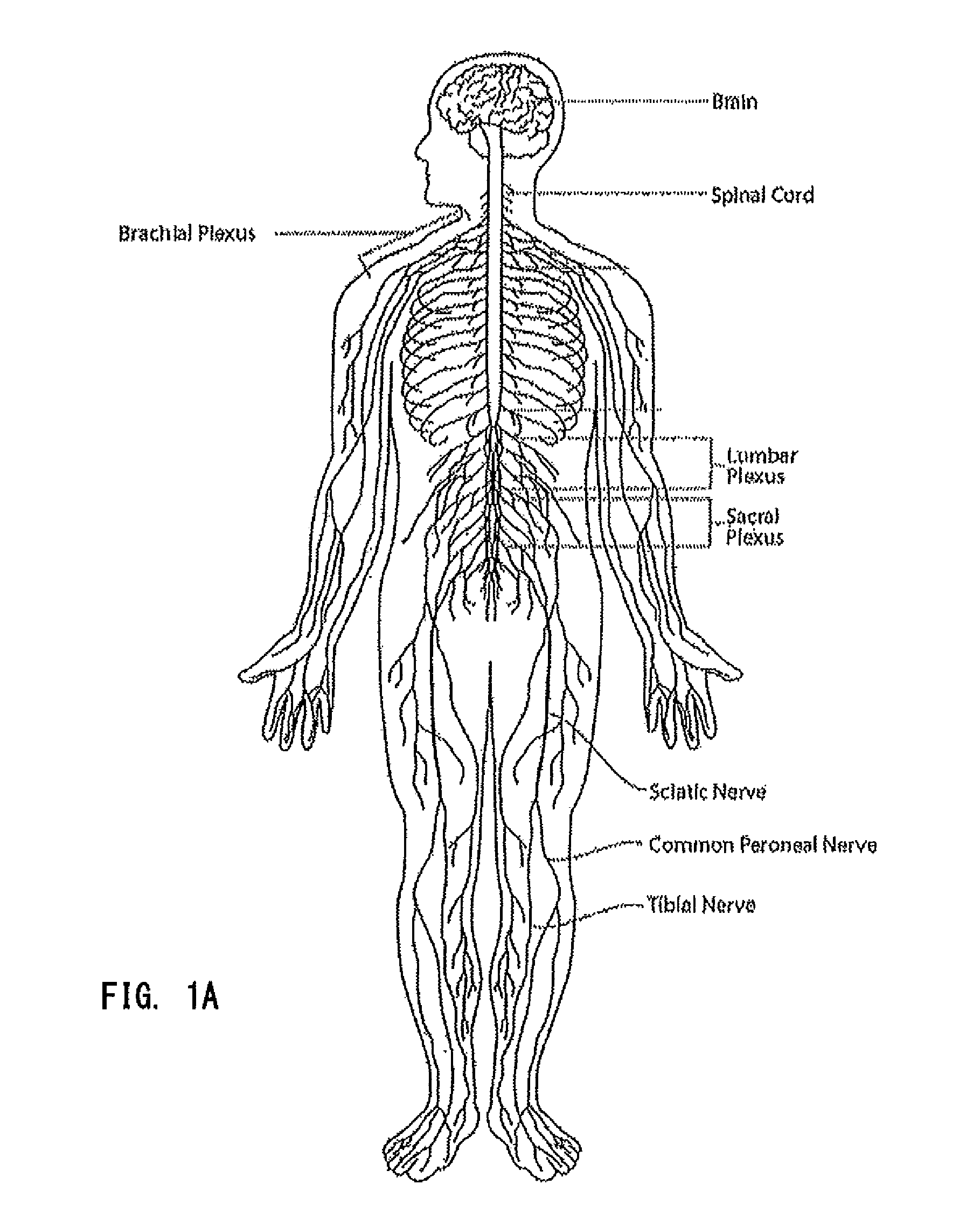 System and method for treatment of pain related to limb joint replacement surgery