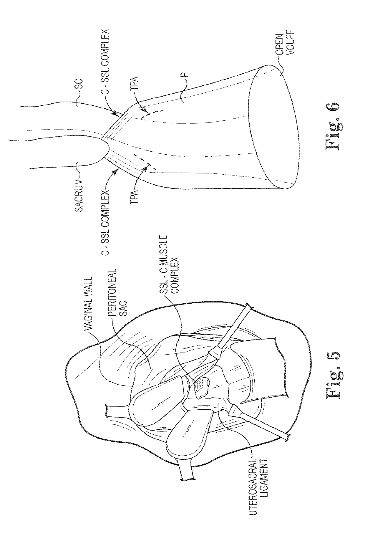 Transperitoneal prolapse repair system and method priority