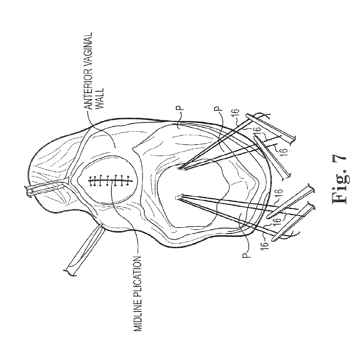 Transperitoneal prolapse repair system and method priority