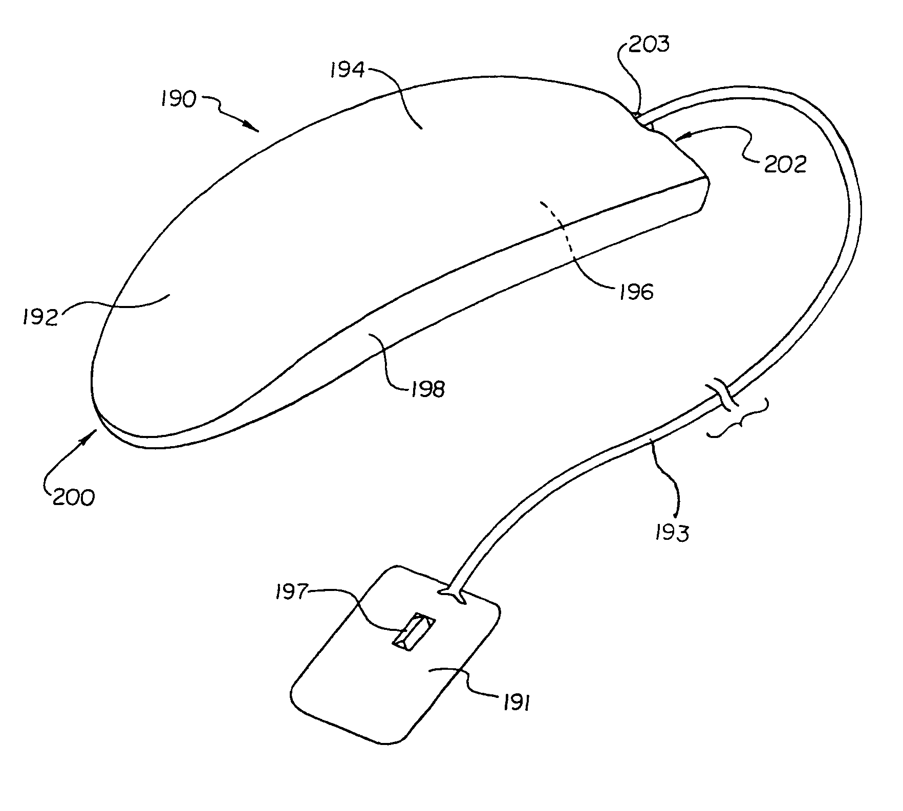 Duckbill-shaped implantable cardioverter-defibrillator canister and method of use