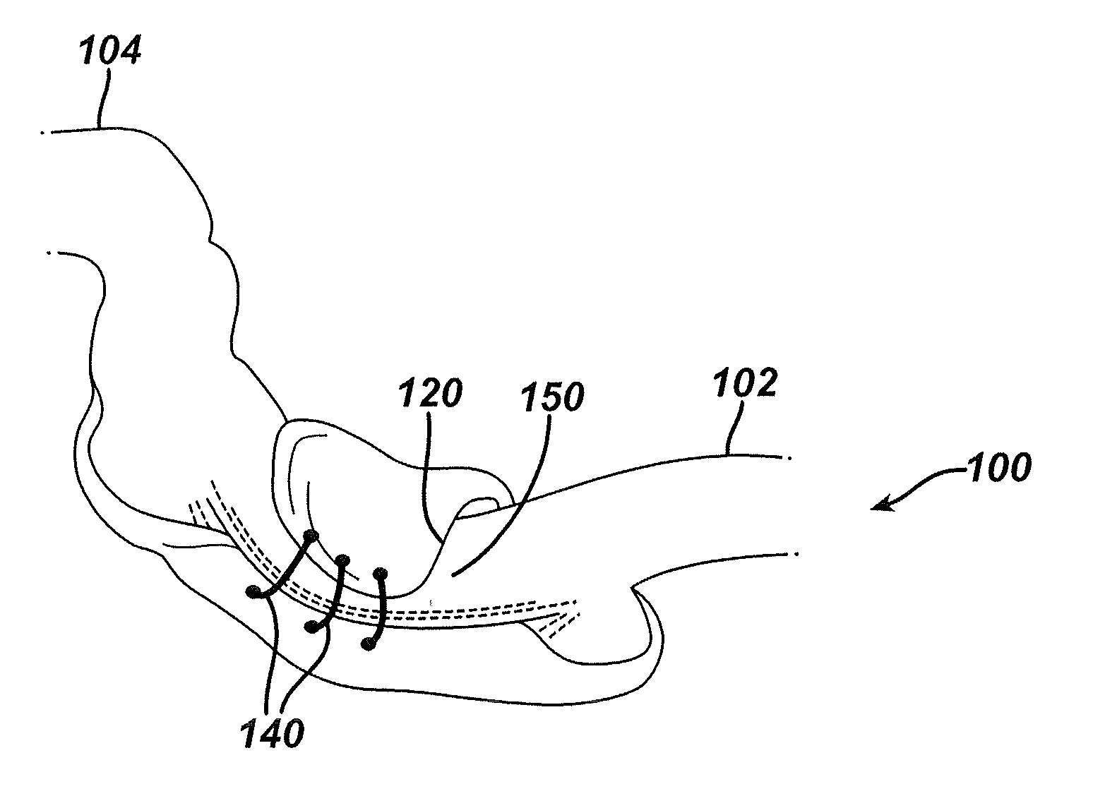 Systems and methods for gastric volume regulation