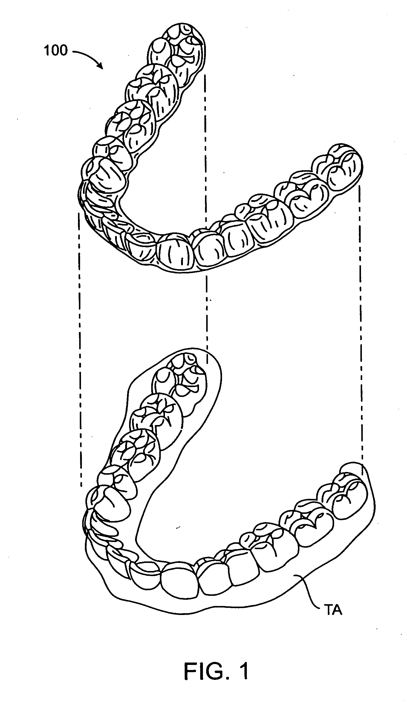 Method and kits for forming pontics in polymeric shell aligners