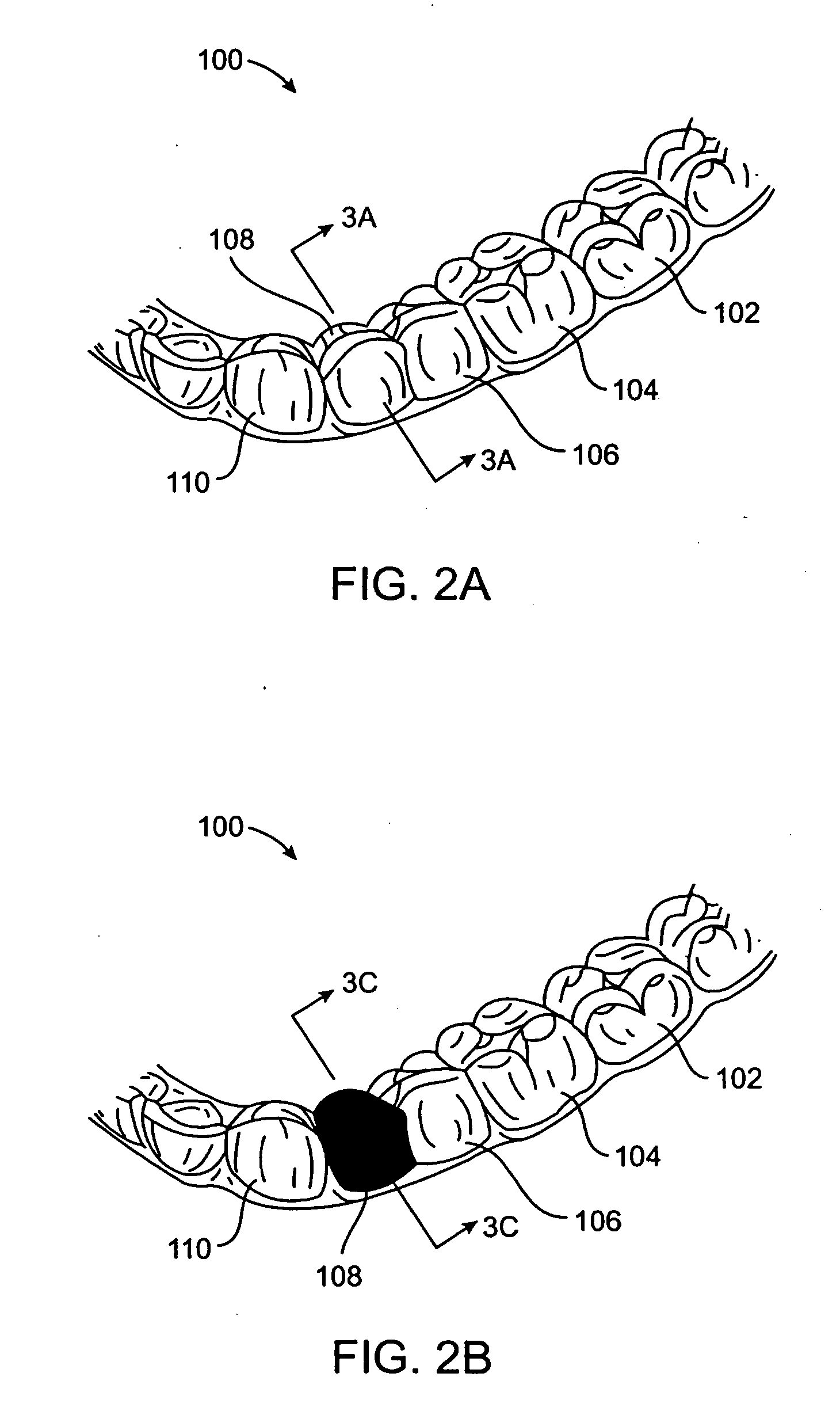 Method and kits for forming pontics in polymeric shell aligners