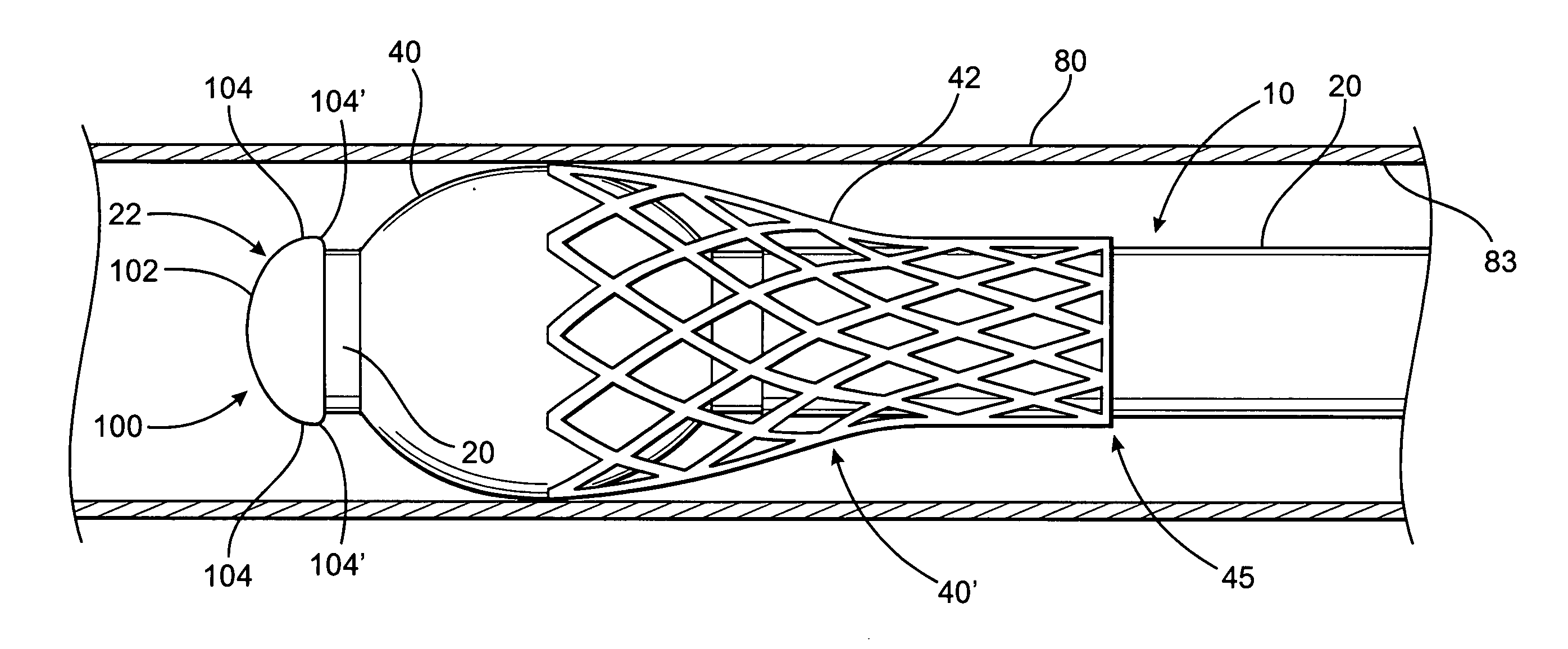 Cleaning assembly for an endotracheal tube