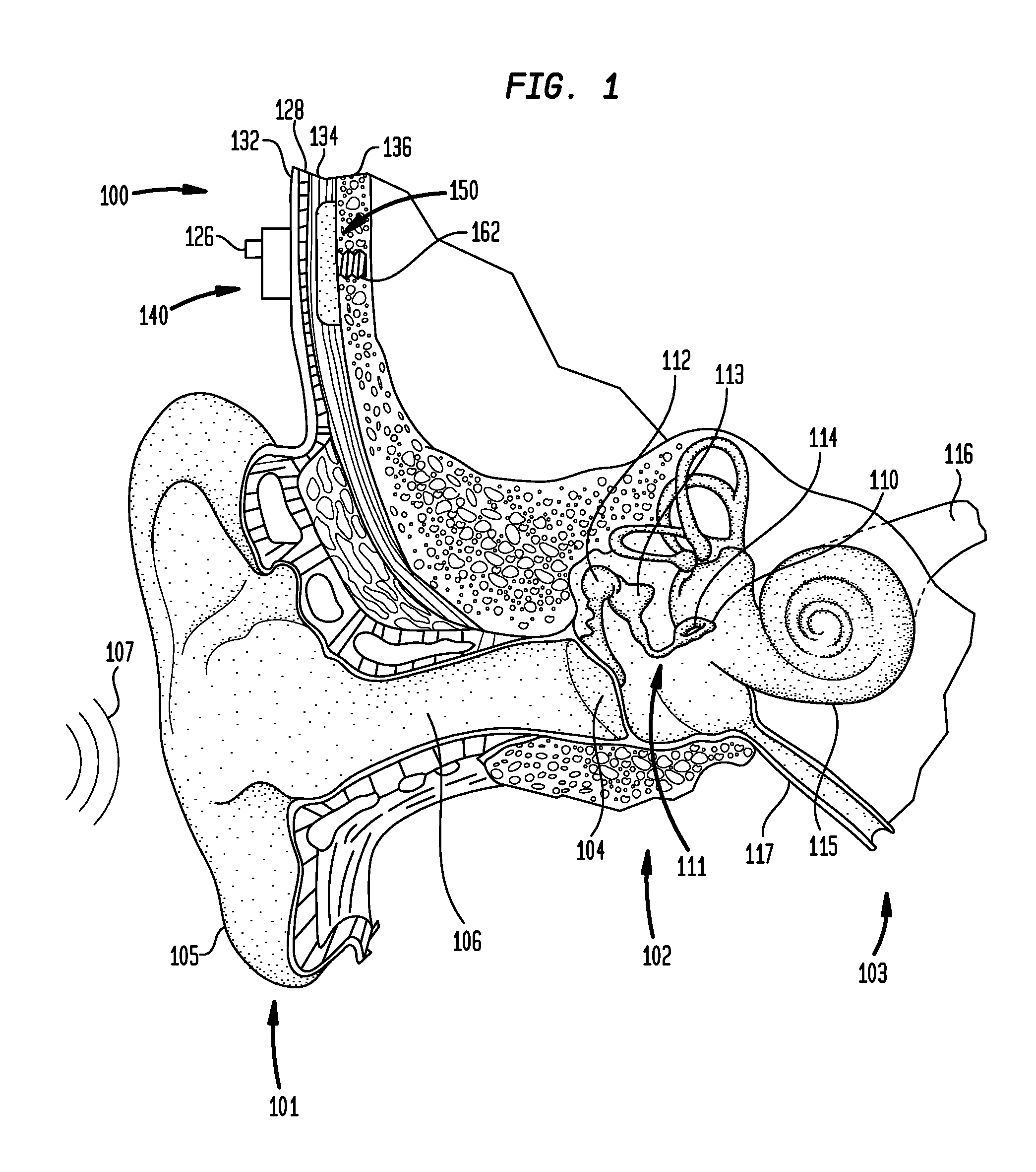 Implantable component of a hearing prosthesis