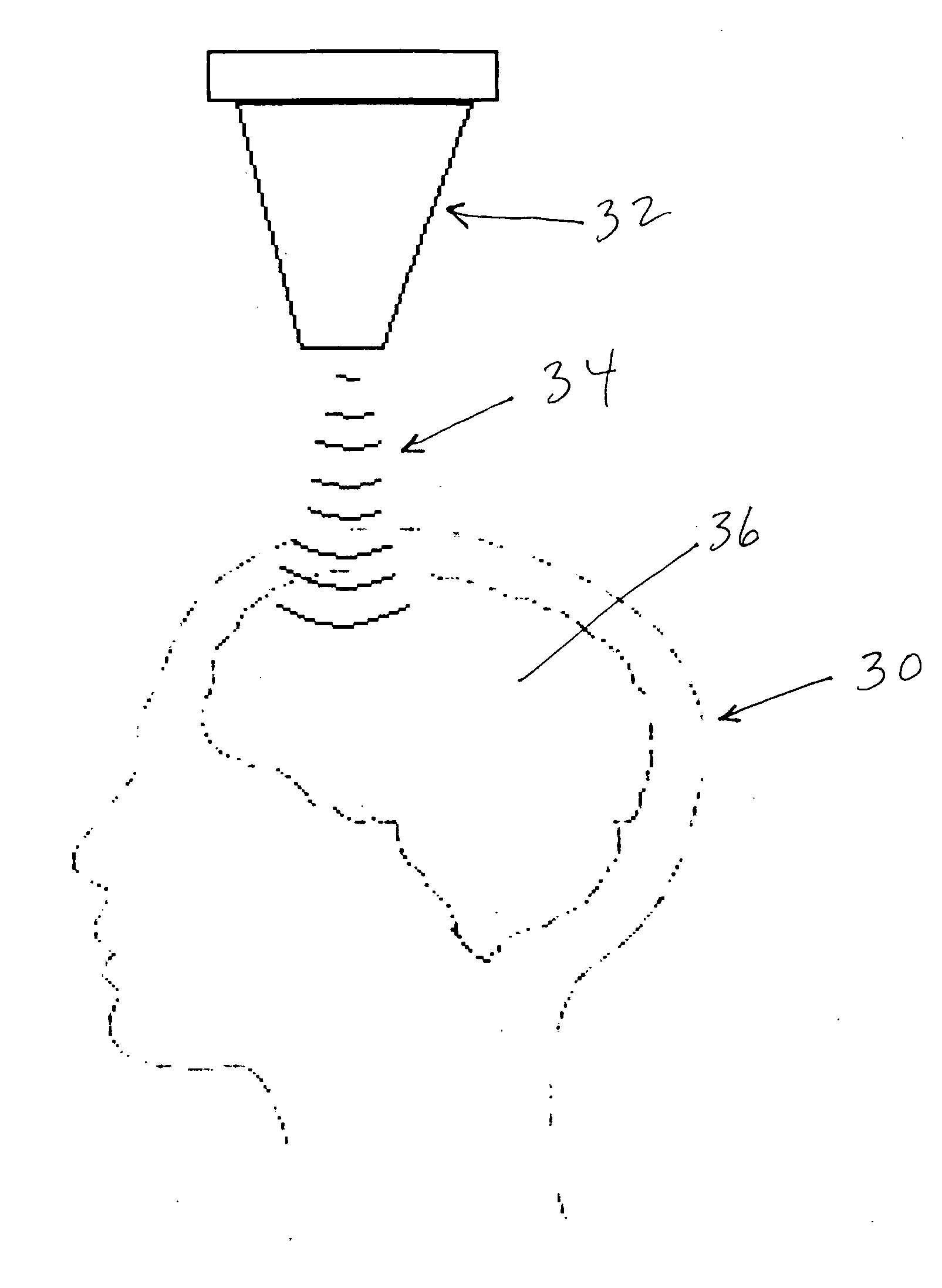 Method and devices for treatment of neurological stroke