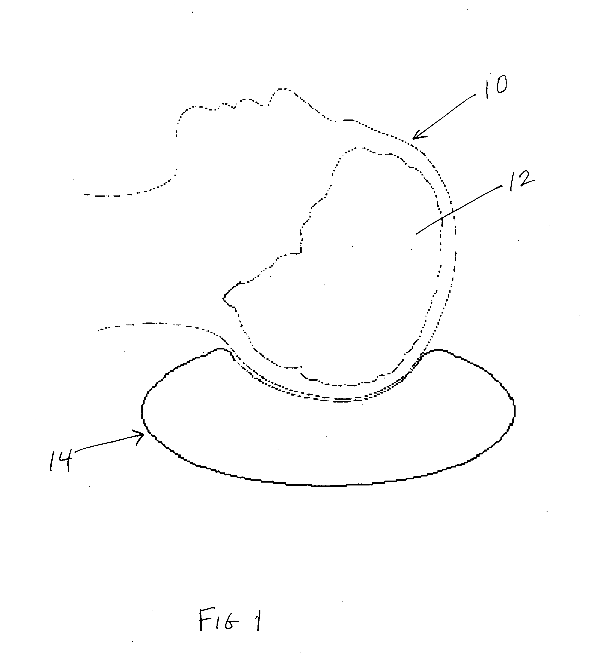 Method and devices for treatment of neurological stroke