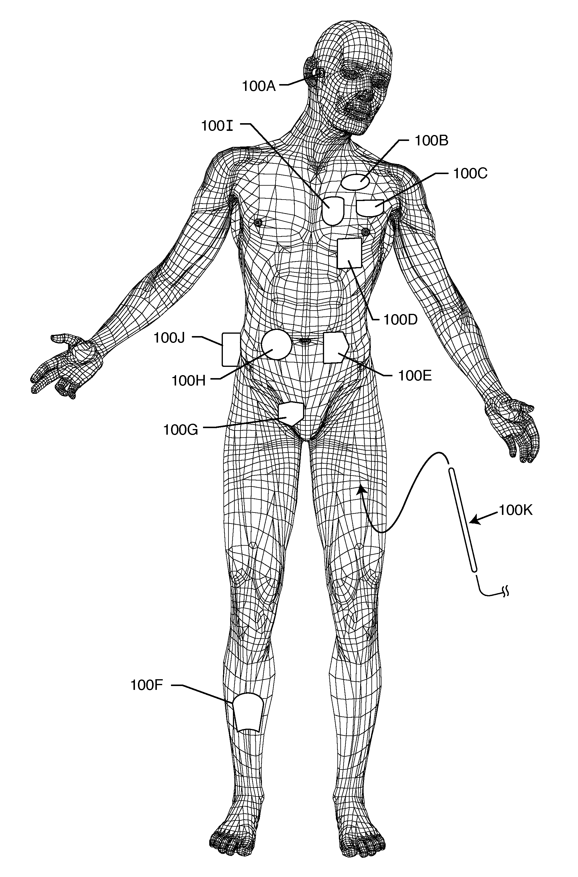 Implantable lead bandstop filter employing an inductive coil with parasitic capacitance to enhance MRI compatability of active medical devices