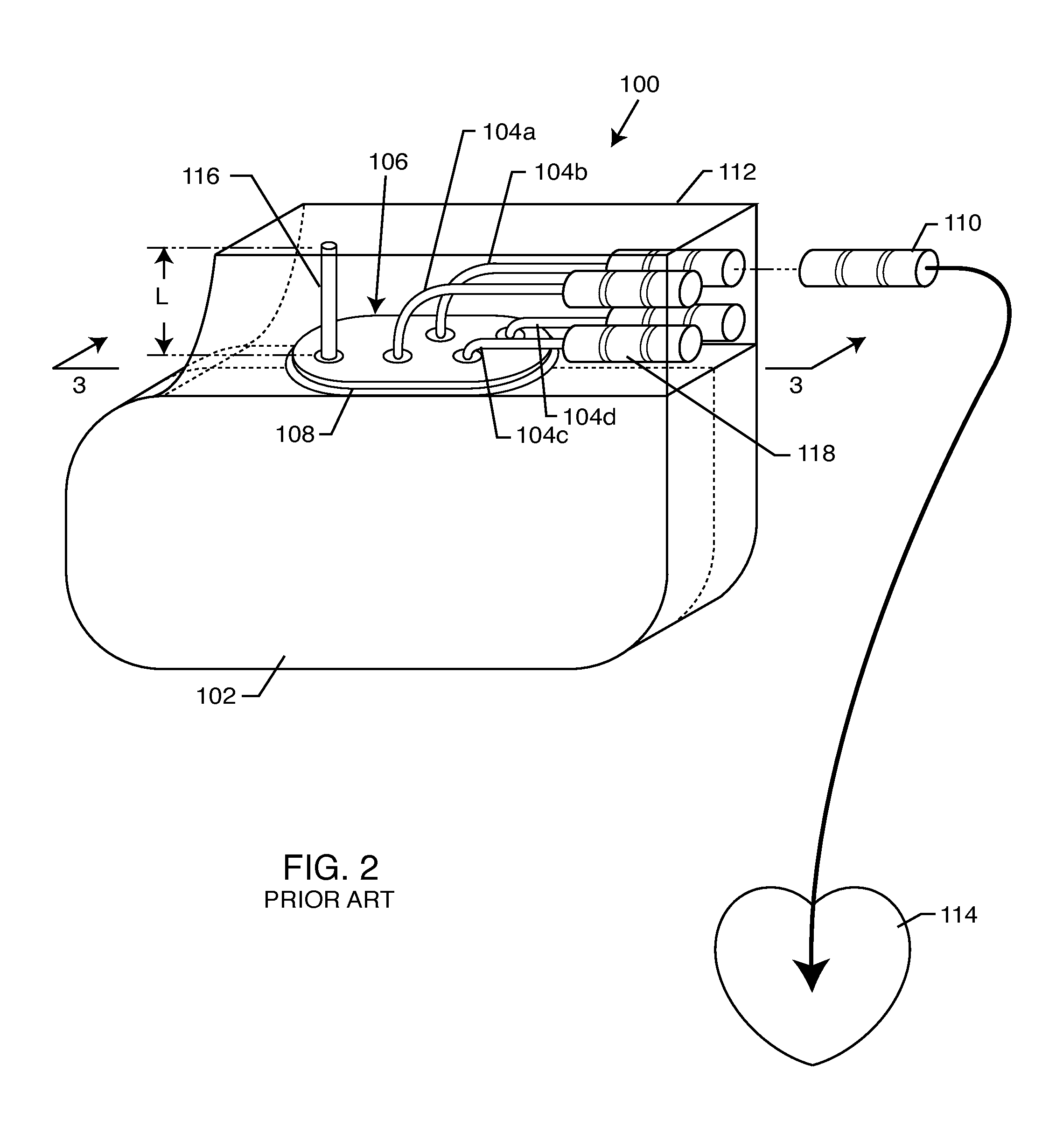 Implantable lead bandstop filter employing an inductive coil with parasitic capacitance to enhance MRI compatability of active medical devices