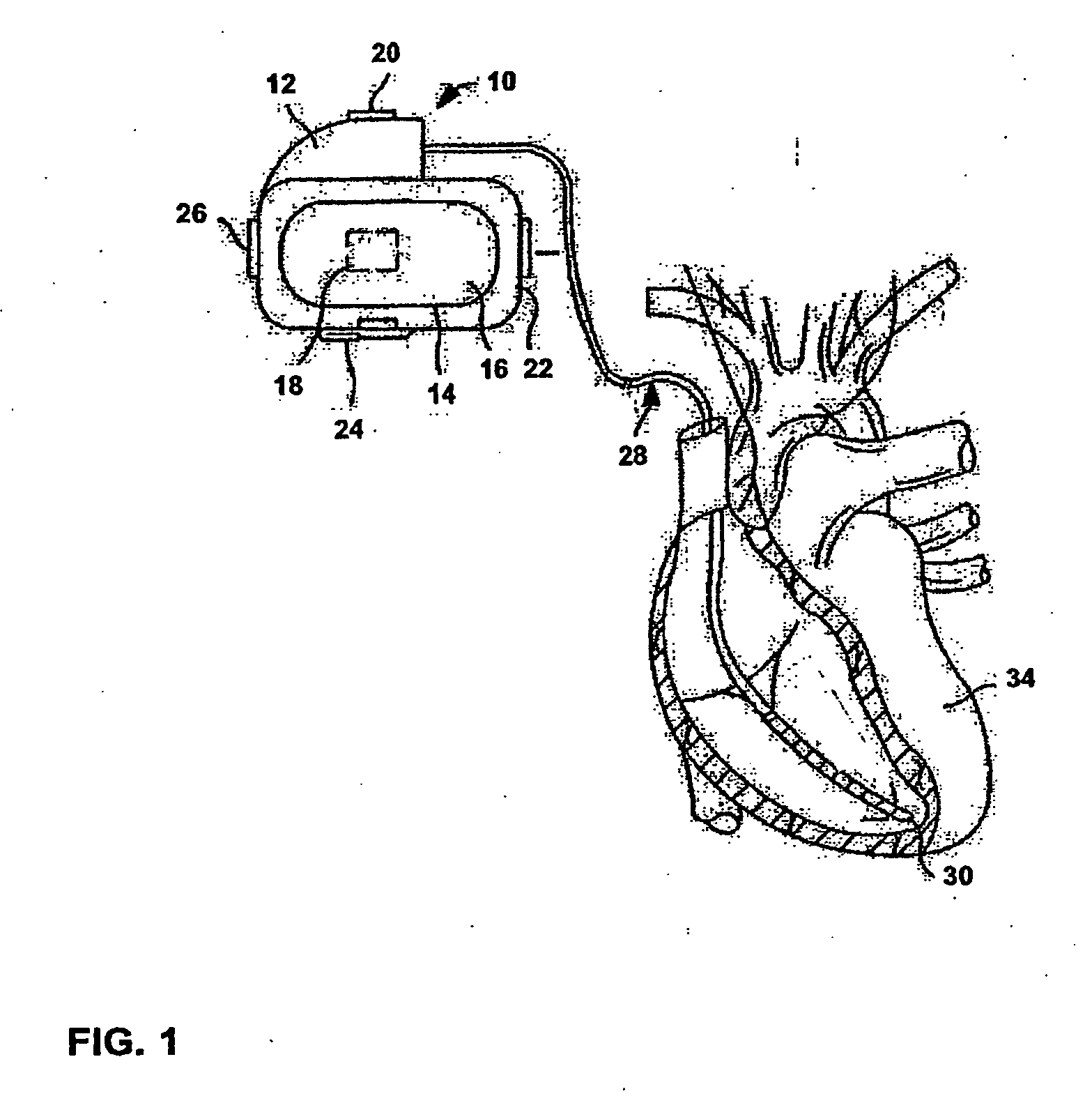 Ischemia detection