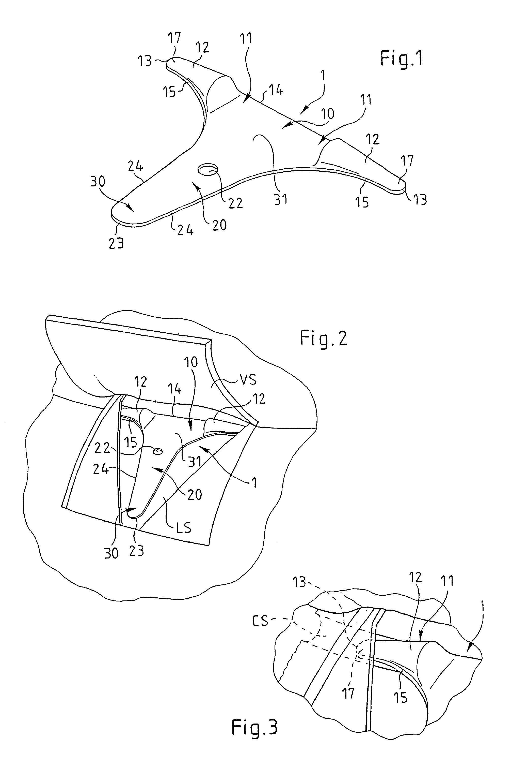 Glaucoma drain