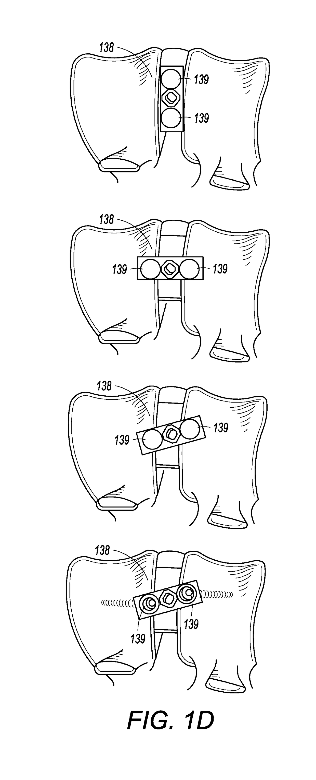 Interbody cage with spill-free biological material compartment