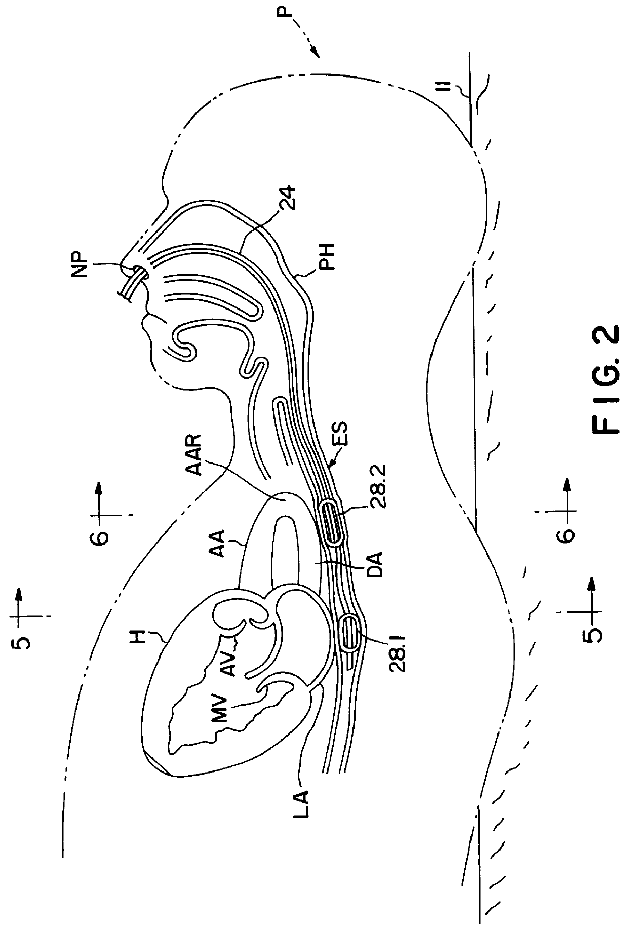 Method and apparatus for noninvasive determination of cardiac performance parameters