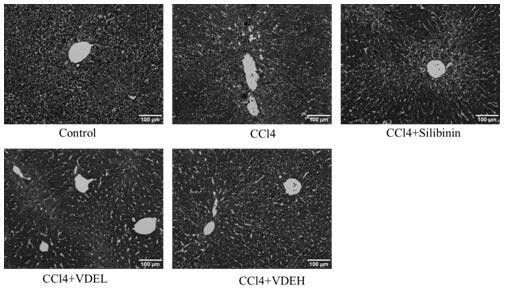 Application of vaccinium dunalianum wight or extract thereof in preparation of medicines or health-care products for preventing and treating hepatic fibrosis