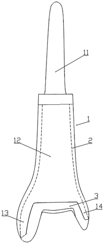 3D printing customized half-ankle joint prosthesis