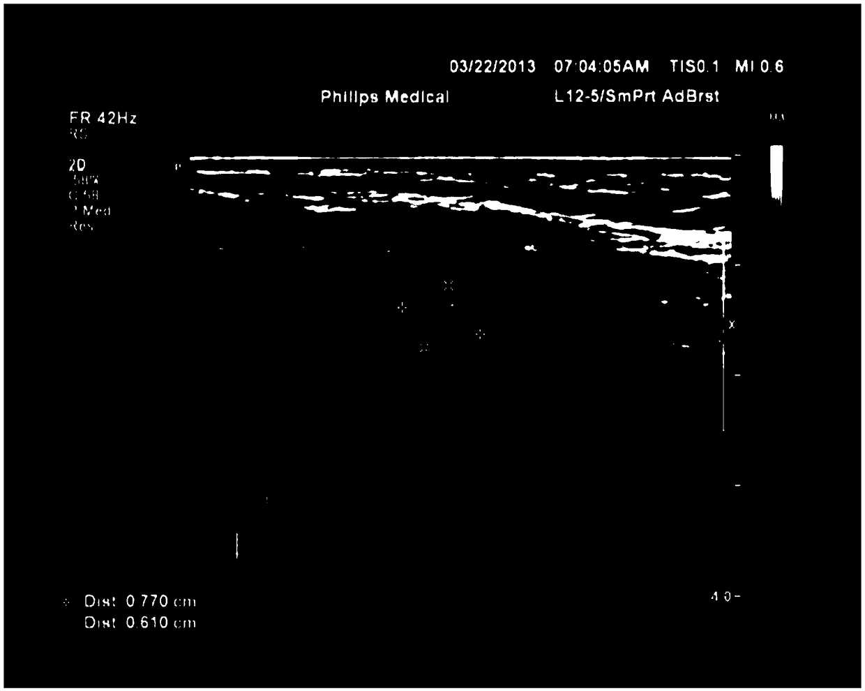 An ultrasound image segmentation method for thyroid nodules based on cascaded total convolution neural network