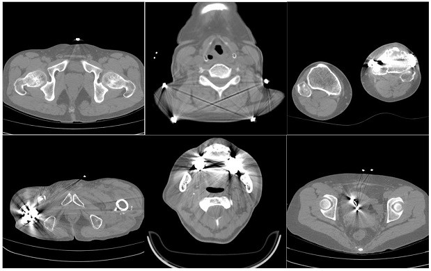 CT image metal artifact removing method and device and computer readable storage medium