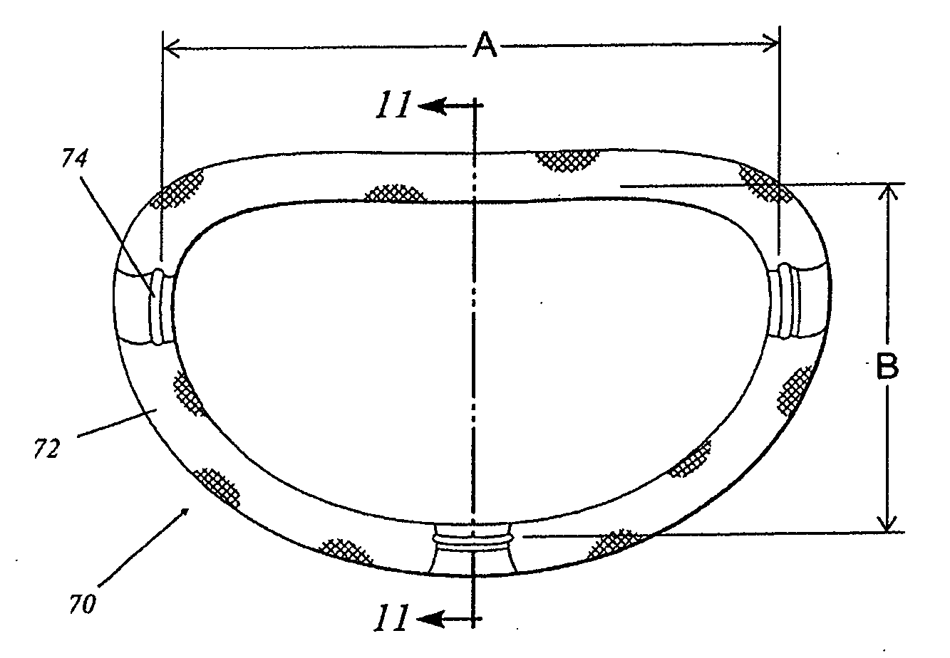 Annuloplasty rings for correcting degenerative valvular diseases