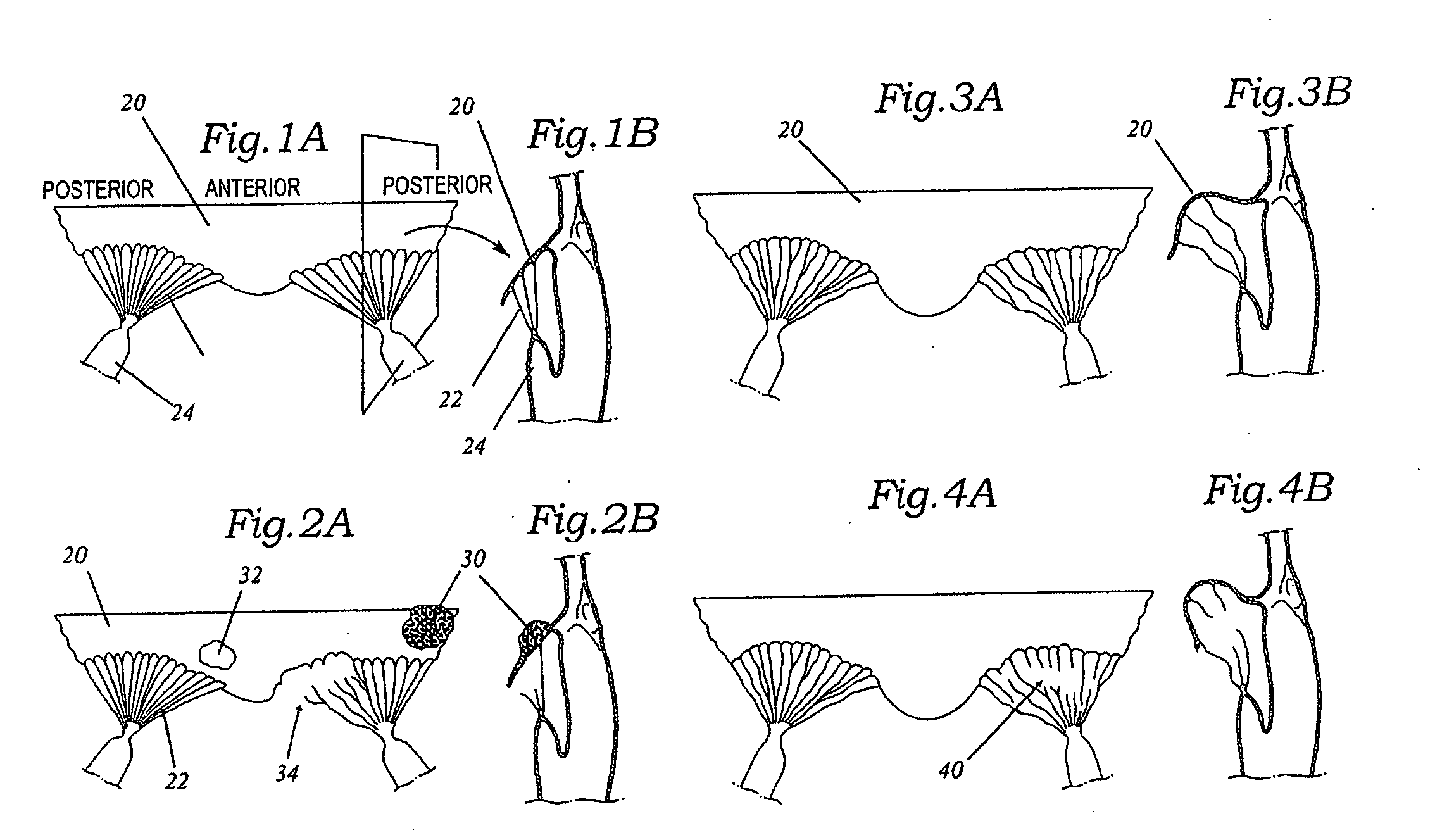 Annuloplasty rings for correcting degenerative valvular diseases